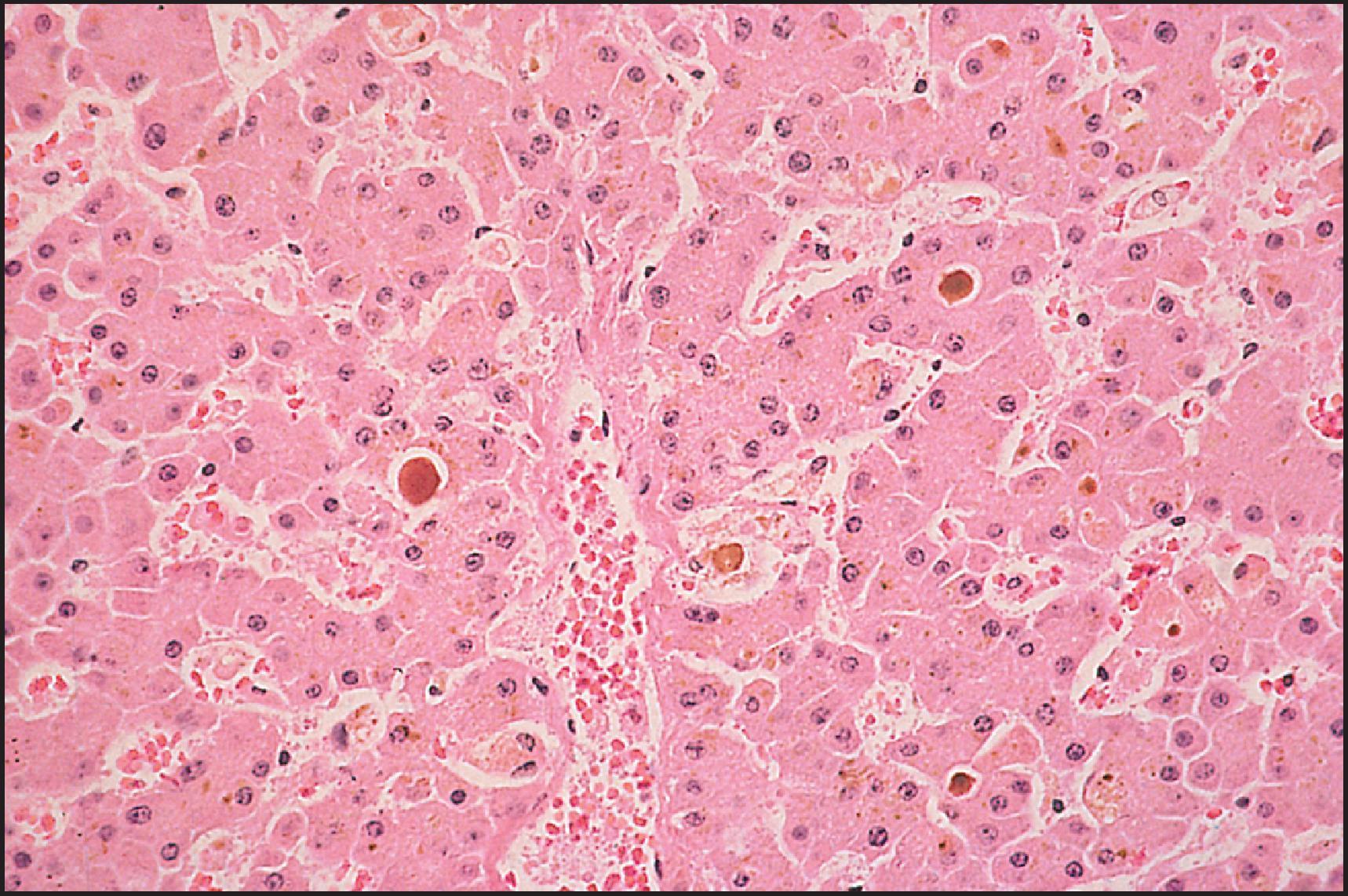 Figure 12.12, Oxymetholone injury. Marked cytoplasmic and canalicular perivenular cholestasis. (H&E.)