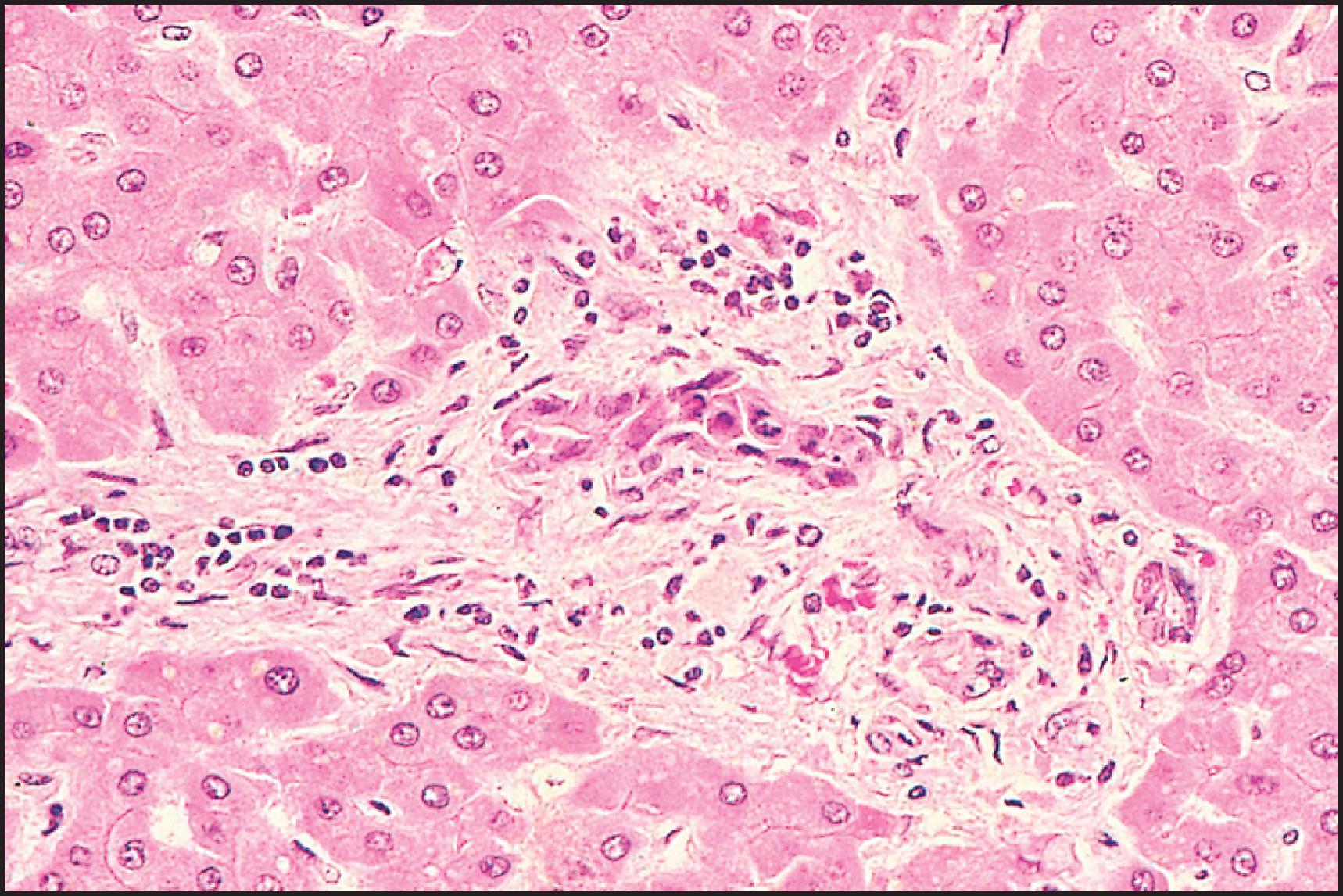 Figure 12.13, Paraquat toxicity. Bile-duct degeneration. (H&E.)