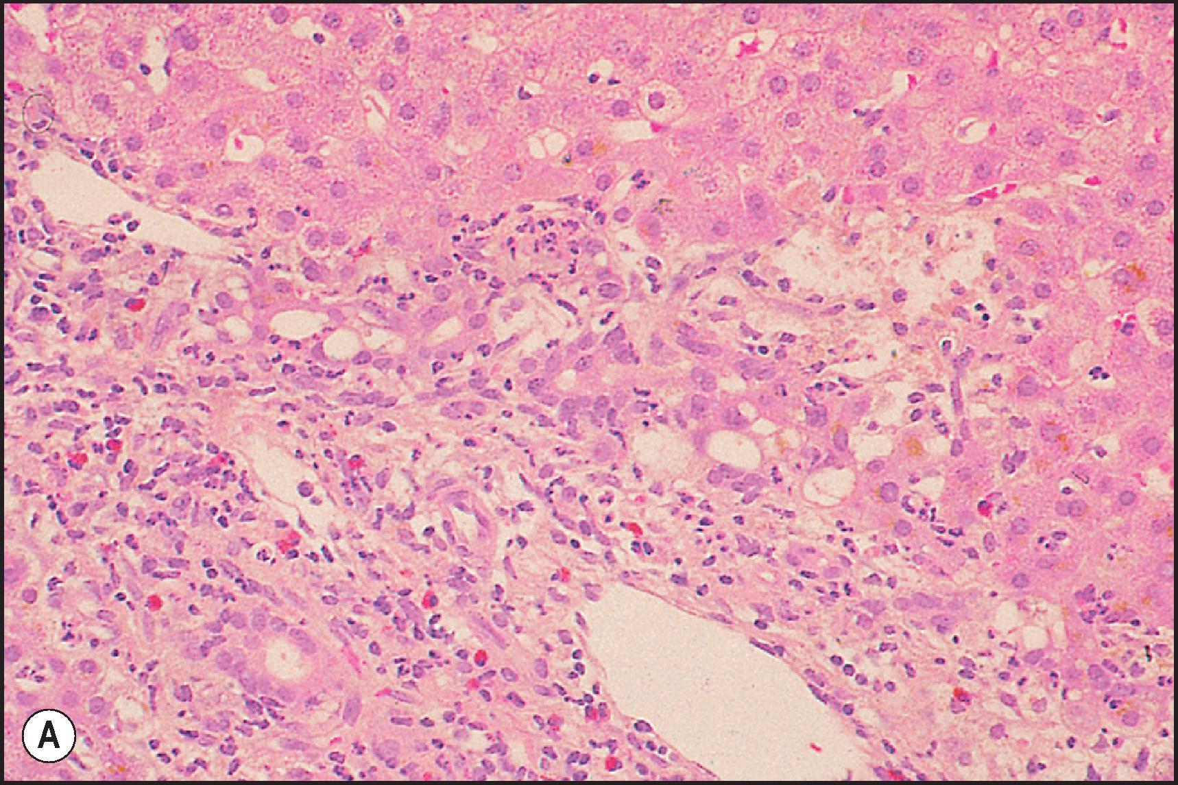 Figure 12.14, Chlorpromazine-induced chronic cholestasis. (A) Marked portal inflammation (neutrophils, eosinophils) and acute cholangiolitis. (H&E.) (B) Periportal focus of pseudoxanthomatous transformation. (H&E.) (C) Moderate cholestasis and focal necrosis (left) . (H&E.) (D) Moderate copper accumulation (red granules) in periportal liver cells. (Rhodanine.)