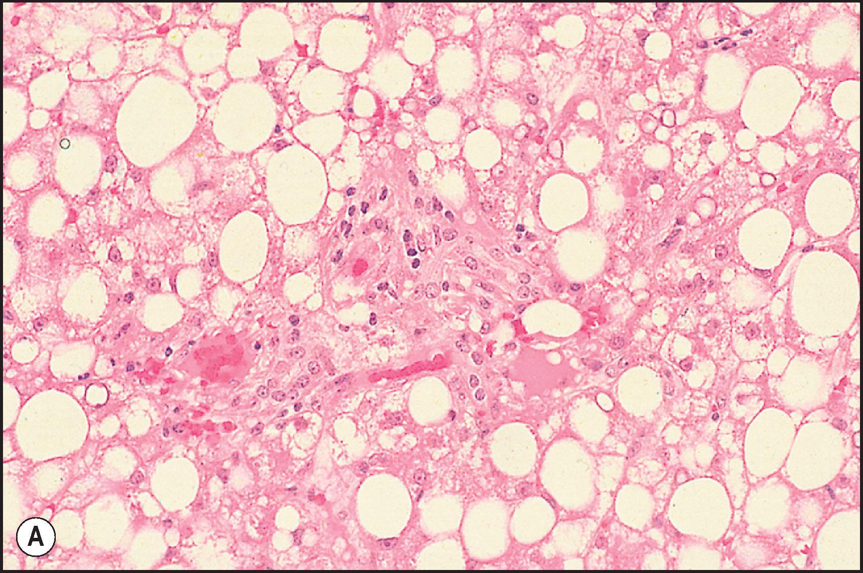 Figure 12.16, Patterns of drug-induced steatosis. (A) Methotrexate injury. Macrovesicular steatosis. (H&E.) (B) Tetracycline injury. Microvesicular steatosis. (H&E.) (C) Liver cells show marked small droplet steatosis. (Oil red O stain.) (D) Asparaginase injury. Lipid vacuoles in liver cells are of medium size. (H&E.)