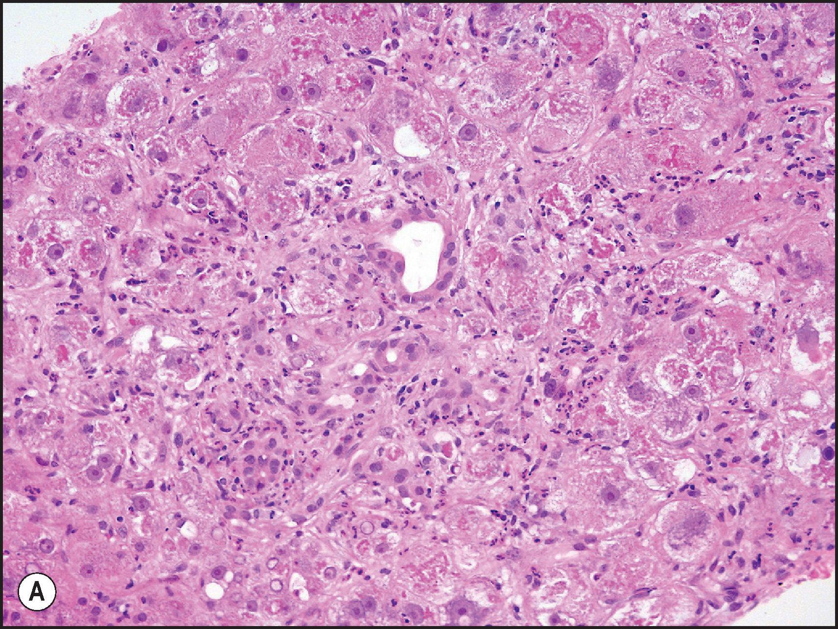 Figure 12.17, Amiodarone injury. (A) Periportal ballooning with numerous large Mallory–Denk bodies. (H&E.) (B) Hepatocytes with Mallory–Denk bodies and neutrophil satellitosis. (H&E.) (C) Amiodarone-induced phospholipidosis with foam cells in the sinusoids. (D) Electron micrograph of hepatocytes in amiodarone-associated phospholipidosis showing two membrane-bound lysosomal structures (asterisks) in a hepatocyte. These structures are composed of densely packed concentric membranous arrays with a fingerprint pattern, which are characteristic of phospholipidosis. Note also altered mitochondria (m) with reduced cristae and increased matrix density and vesiculated smooth endoplasmic reticulum. (Lead citrate, 36,900.) B, Case courtesy of DILIN; D, courtesy of Dr M J Phillips .