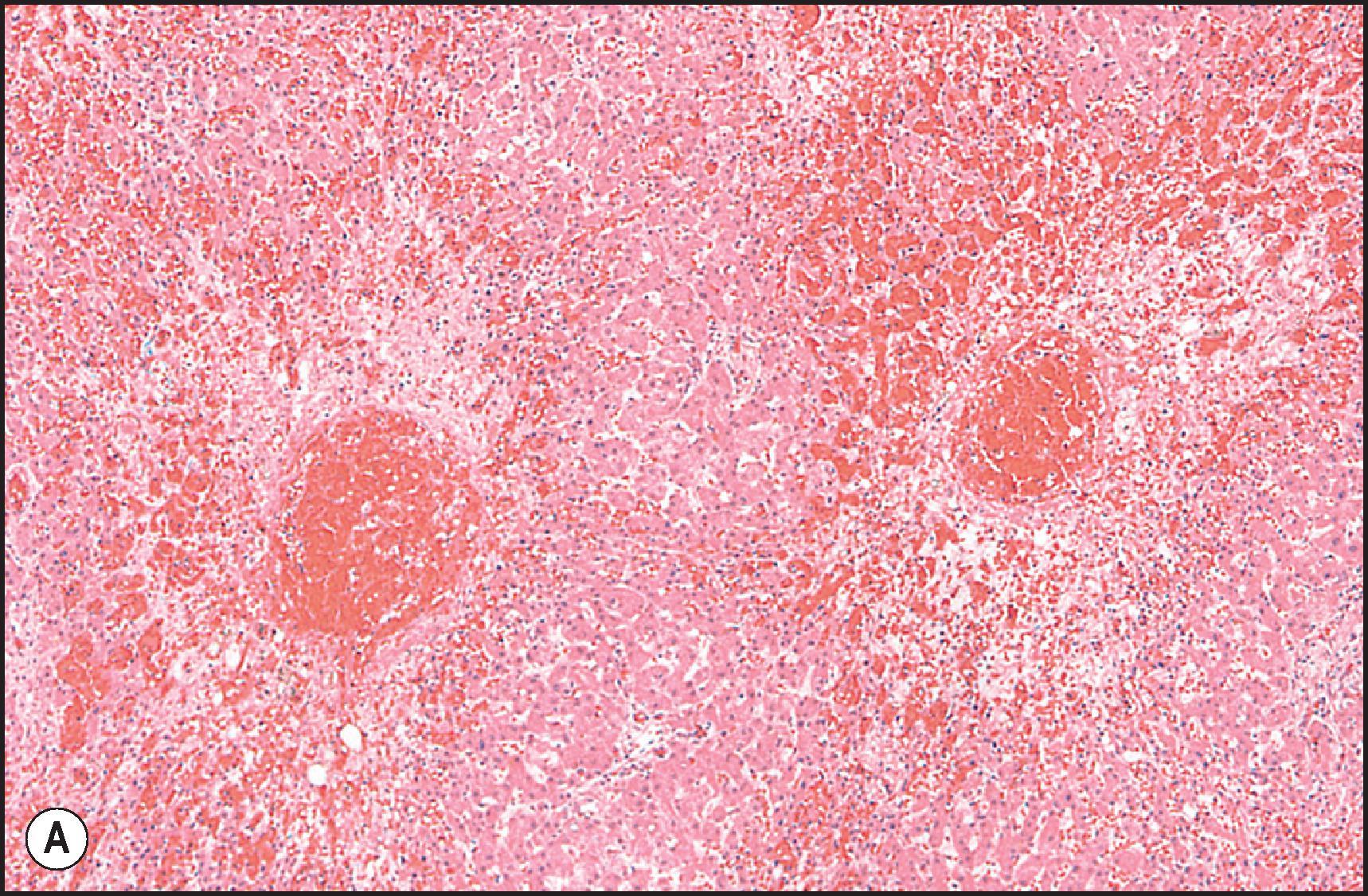 Figure 12.19, Hepatic vein thrombosis associated with long-term use of oral contraceptive. (A) Recent thrombi in two terminal hepatic venules with perivenular zone necrosis and marked sinusoidal dilatation and congestion. (H&E.) (B) Thrombosed and recanalized terminal hepatic venule. (Masson trichrome.)