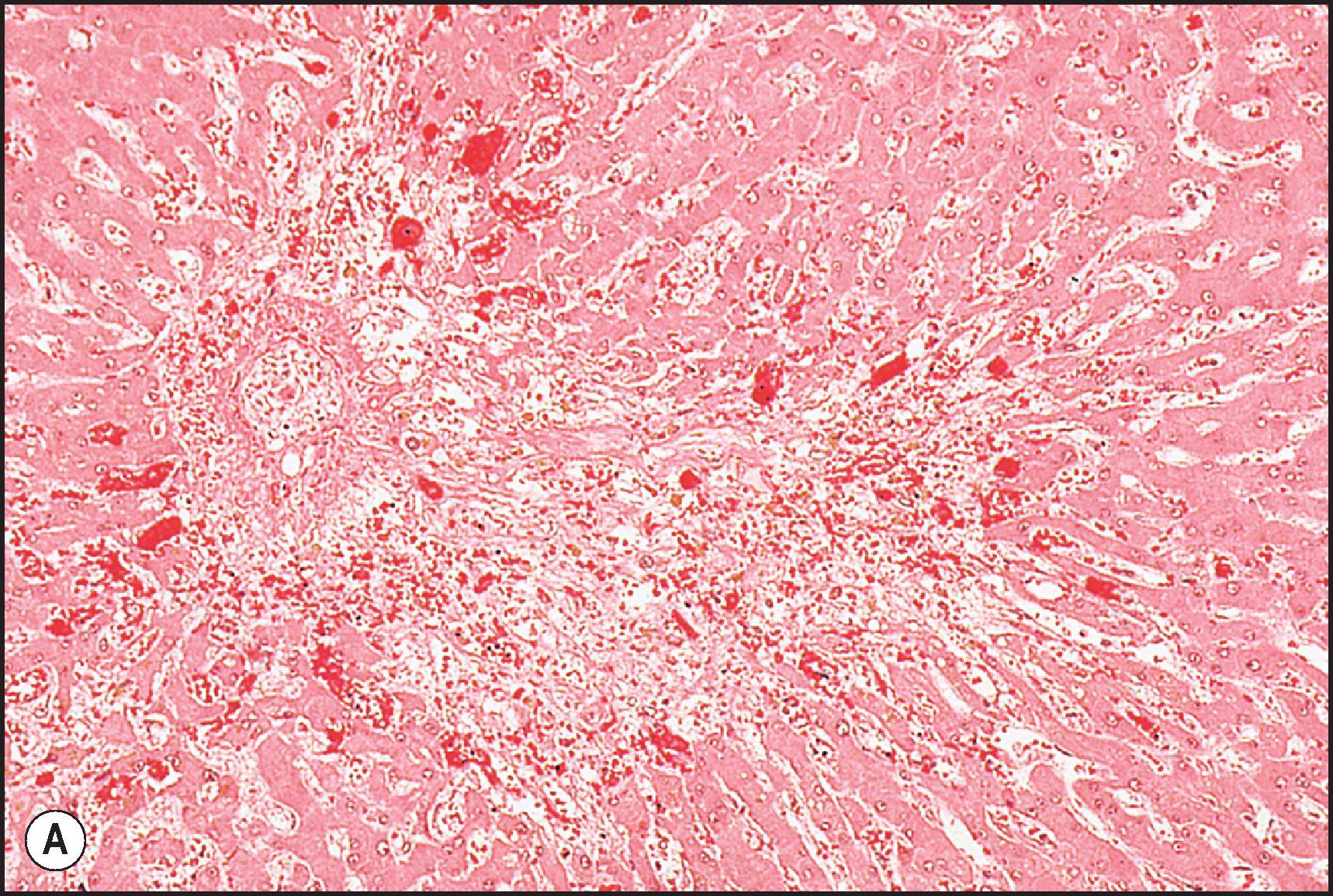 Figure 12.20, Veno-occlusive disease associated with chemoradiation used for preconditioning prior to bone marrow transplantation. (A) Haemorrhagic perivenular necrosis. Terminal hepatic venule (left) shows marked intimal thickening. (H&E.) (B) Wall of the terminal hepatic venule is thickened by oedema, and there are numerous extravasated erythrocytes in the intima. (H&E.) (C) Same features shown in (B) are present but the lumen of the vein is completely occluded. (Masson trichrome.)