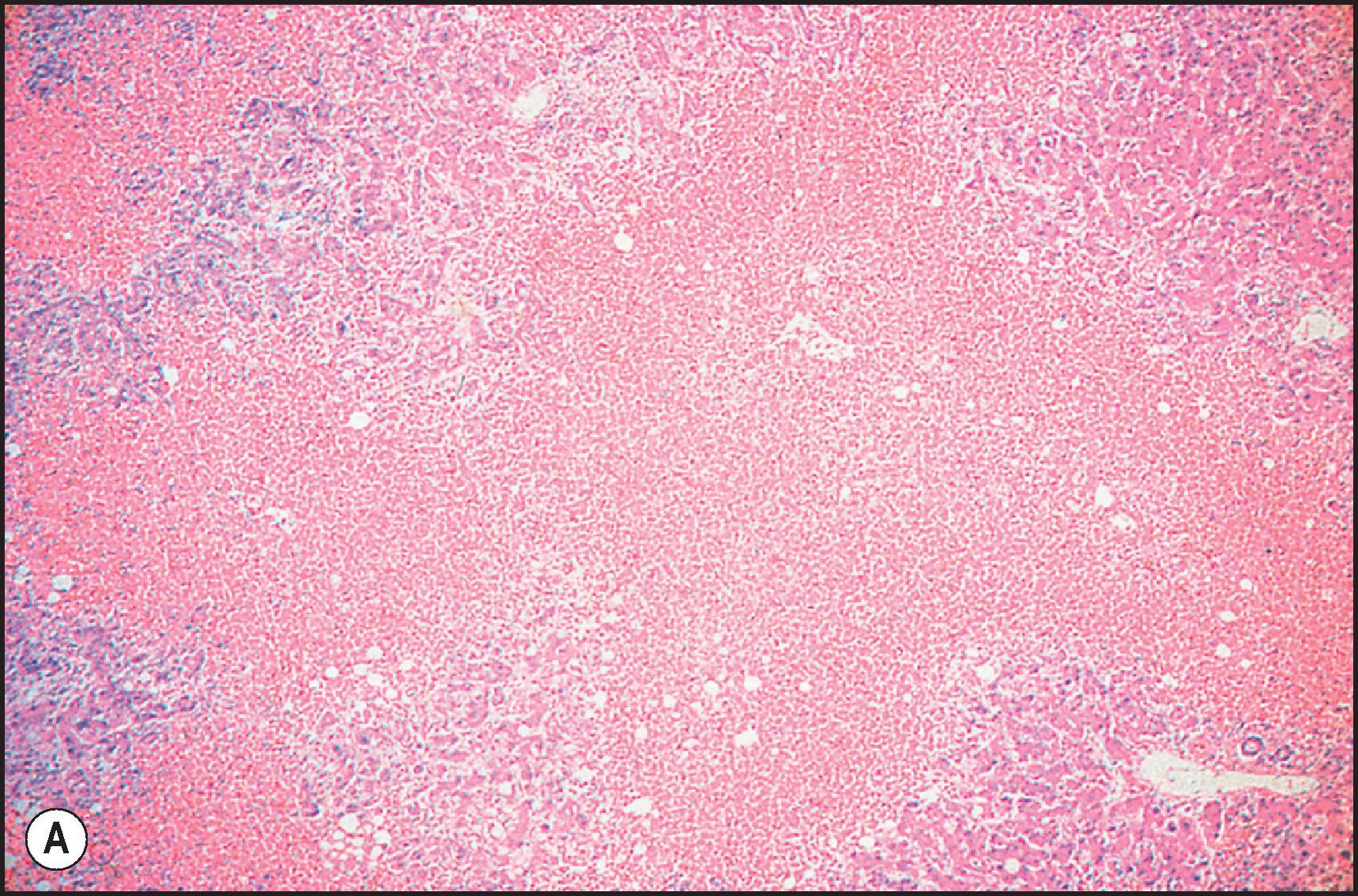 Figure 12.2, Paracetamol (acetaminophen) toxicity. (A) Confluent coagulative necrosis involving the perivenular and mid-zones. (Haematoxylin & eosin [H&E].) (B) Necrotic hepatocytes are shrunken, eosinophilic, rounded and have lost their nuclei. (H&E.)