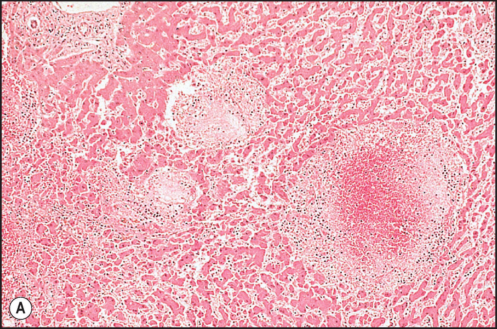 Figure 12.21, Peliosis hepatis associated with oxymetholone therapy given to patient with aplastic anaemia. (A) Peliotic cavities are of variable size. (H&E.) (B) Blood in cavity is clotted, with fibrin accumulation at the periphery of the cavity. The cavity has no endothelial lining. (H&E.)