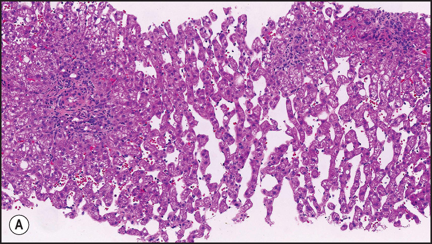 Figure 12.22, Sinusoidal dilatation associated with long-term use of oral contraceptive. (A) Note portal areas on either side of field. (H&E.) (B) Atrophy of liver plates and striking sinusoidal dilatation with ‘floating’ hepatocytes. (H&E.) Case courtesy of A. Burt.