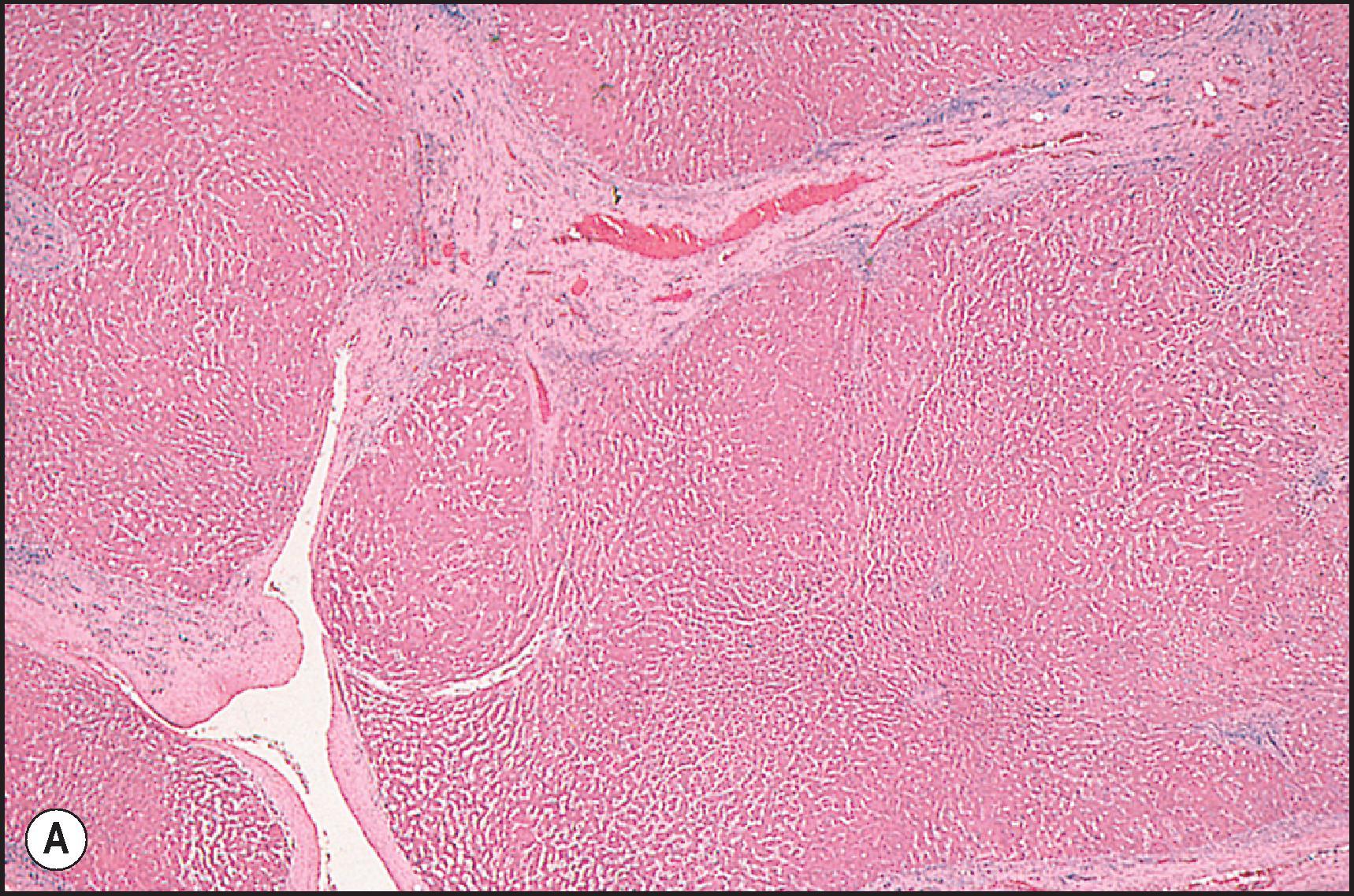 Figure 12.23, Hepatoportal sclerosis. (A) Irregular portal-portal bridging fibrosis, patchy portal inflammation, and ill-defined nodularity of the parenchyma. (H&E.) The aetiology is unknown but the lesion is typical of that seen after long-term exposure to inorganic trivalent arsenic. (B) Markedly expanded acellular portal area (left) and portal-portal fibrous bridge (right) . (Masson trichrome.) Figure 12.23, cont’d(C) Expanded portal area lacks portal vein branches with a diameter corresponding to its size. There is patchy infiltration with lymphocytes and plasma cells. (H&E.) (D) Occluded portal vein branch is readily identified by an elastic stain. (Orcein.)