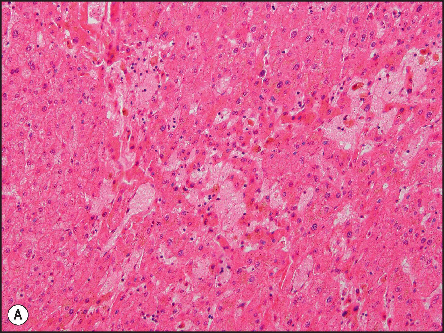 Figure 12.24, Oxaliplatin associated microvascular injury and nodular regenerative hyperplasia. (A) Sinusoidal dilation with hepatocyte atrophy. (H&E.) (B) Nodules of widened liver cell plates bounded by compressed, atrophic liver cell plates. (Reticulin.)