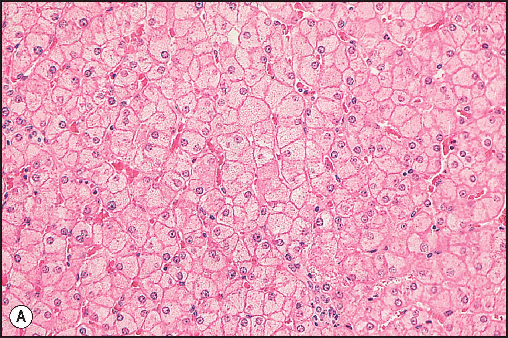 Figure 12.25, Enzymic induction associated with long-term therapy with phenytoin. Liver cells are markedly enlarged and have a lightly stained, very finely vesiculated cytoplasm. Nuclei are located either centrally or eccentrically. (H&E.)