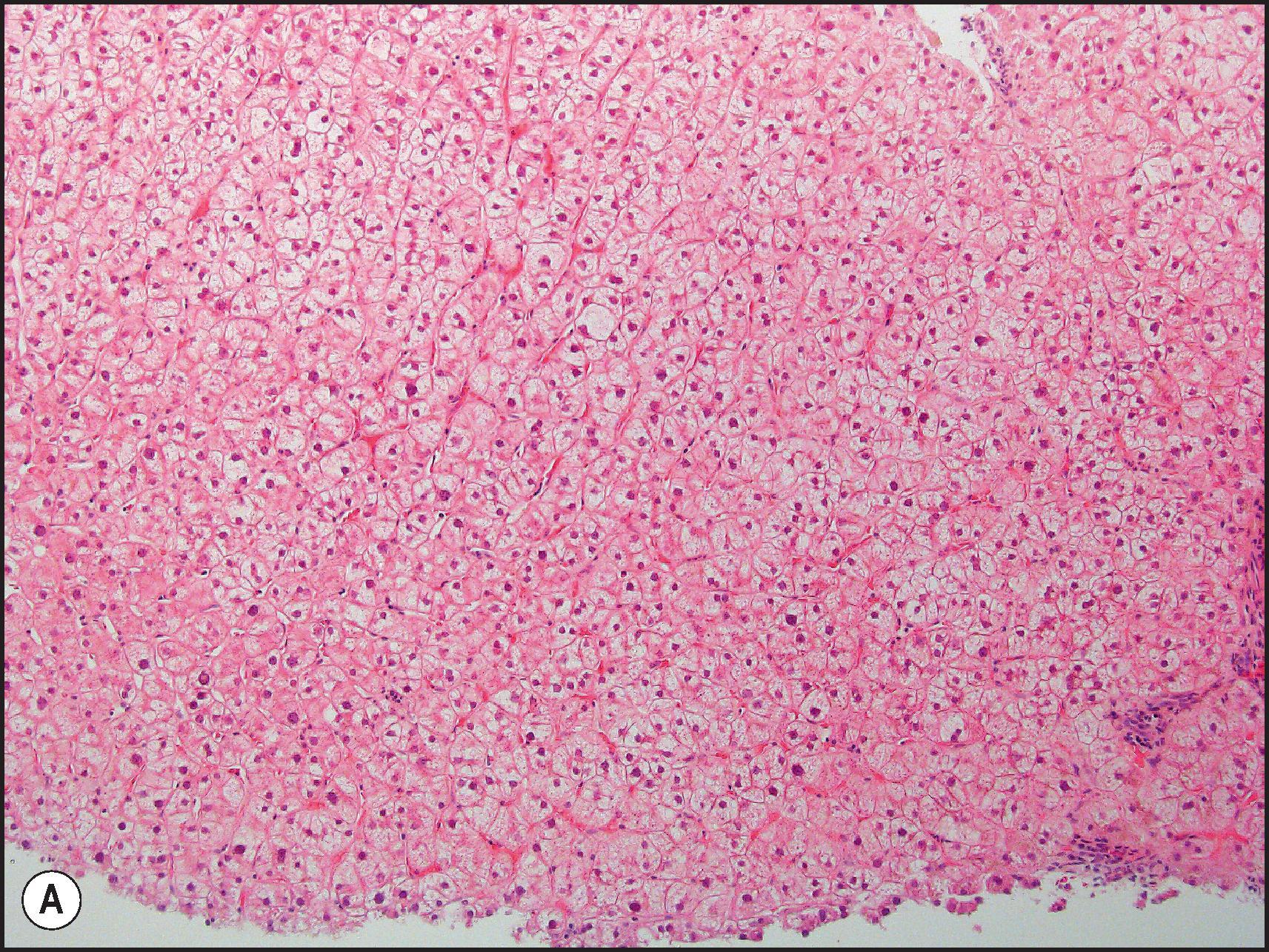 Figure 12.27, Corticosteroid induced glycogenosis. (A) Low power examination shows enlarged hepatocytes with pale cytoplasm. (H&E.) (B) Under high magnification, the cytoplasm is noted to be filled with a very pale, greyish, glassy substance. (H&E.)