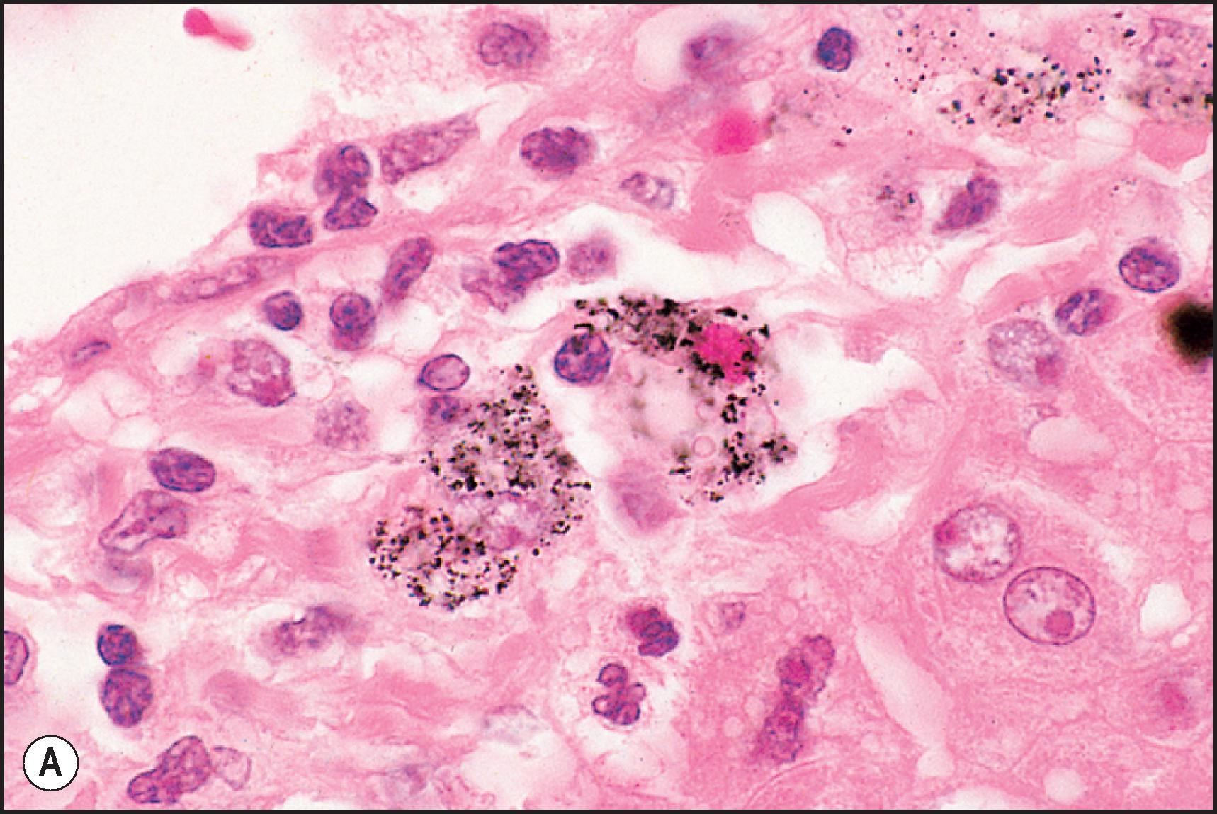 Figure 12.28, Patient who had received gold therapy for rheumatoid arthritis. (A) Granular, black pigment in Kupffer cells. (H&E.) (B) Pigment granules display a golden birefringence in polarized light.