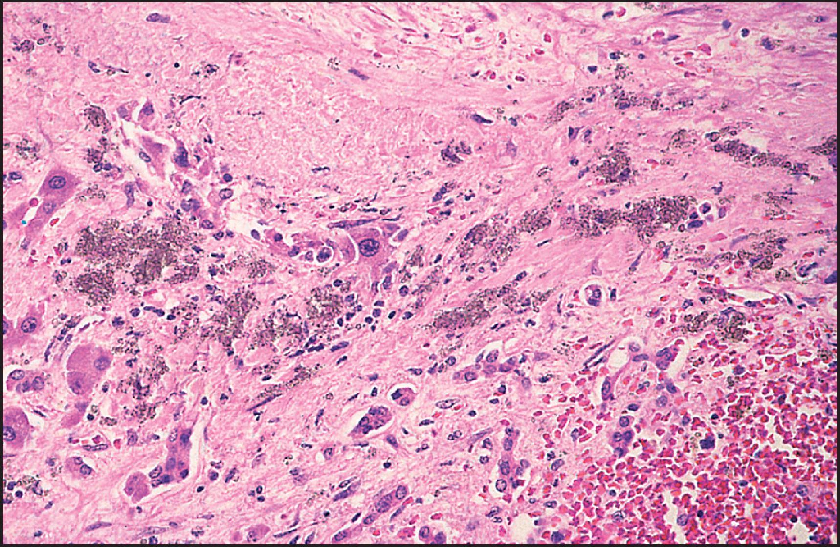 Figure 12.29, Thorotrast. Coarsely granular deposits of Thorotrast are pink brown in colour and are surrounded by dense fibrous tissue. (H&E.)