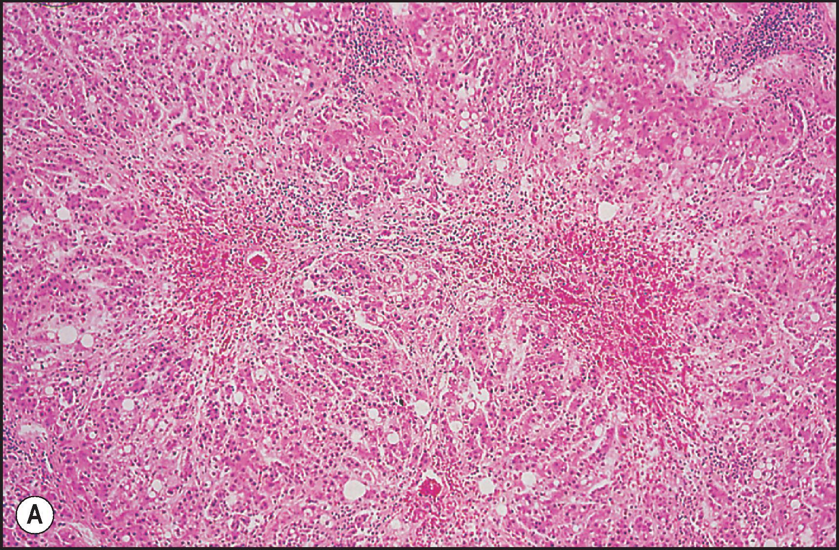 Figure 12.30, Toxic necrosis. (A) Carbon tetrachloride toxicity with bridging perivenular necrosis. Note focal steatosis in preserved parenchyma. (H&E.) (B) Phosphorus toxicity showing zone 1 necrosis with a mild lymphocytic infiltrate. (H&E.) Case courtesy of P. Bedossa.