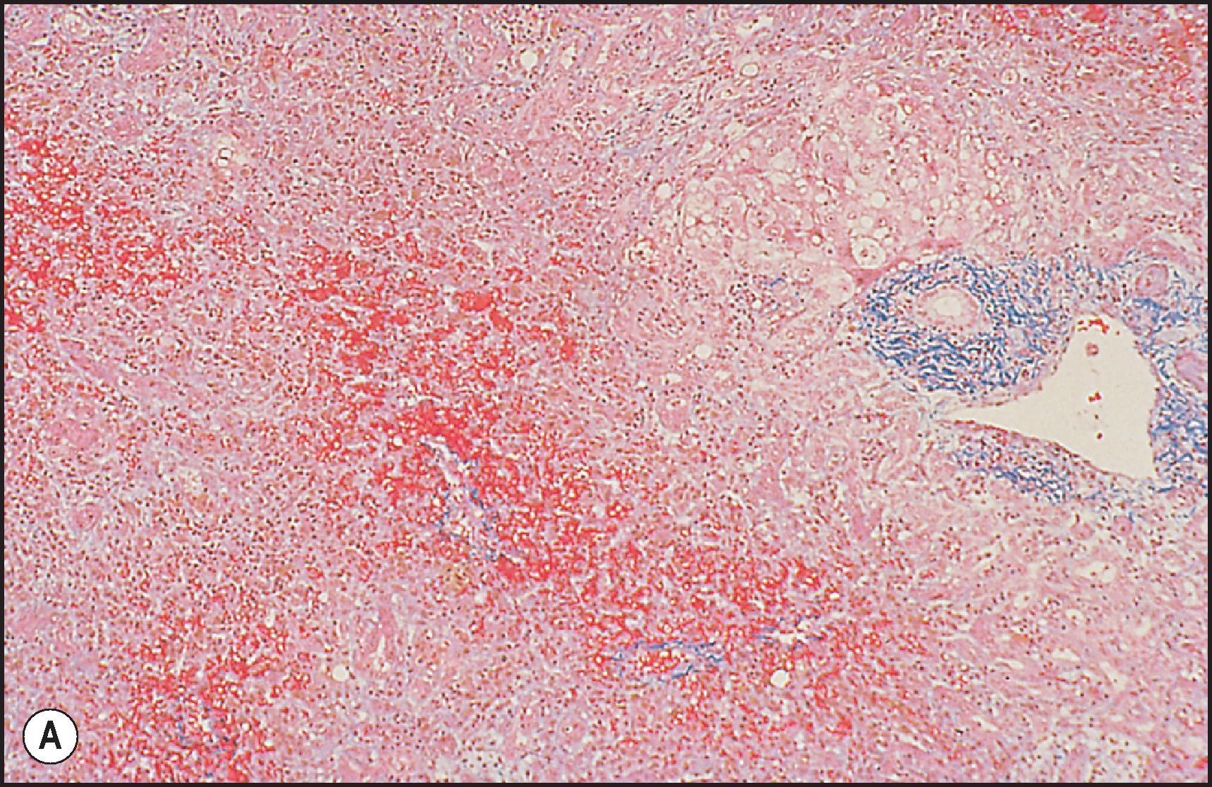 Figure 12.31, Mushroom toxicity. (A) Bridging perivenular necrosis with marked sinusoidal congestion. (Masson trichrome.) (B) Haematoxylin and eosin-stained section. (C) Higher magnification showing drop-out of liver cells and stromal inflammation. Note macrovesicular steatosis of residual hepatocytes. (H&E.)