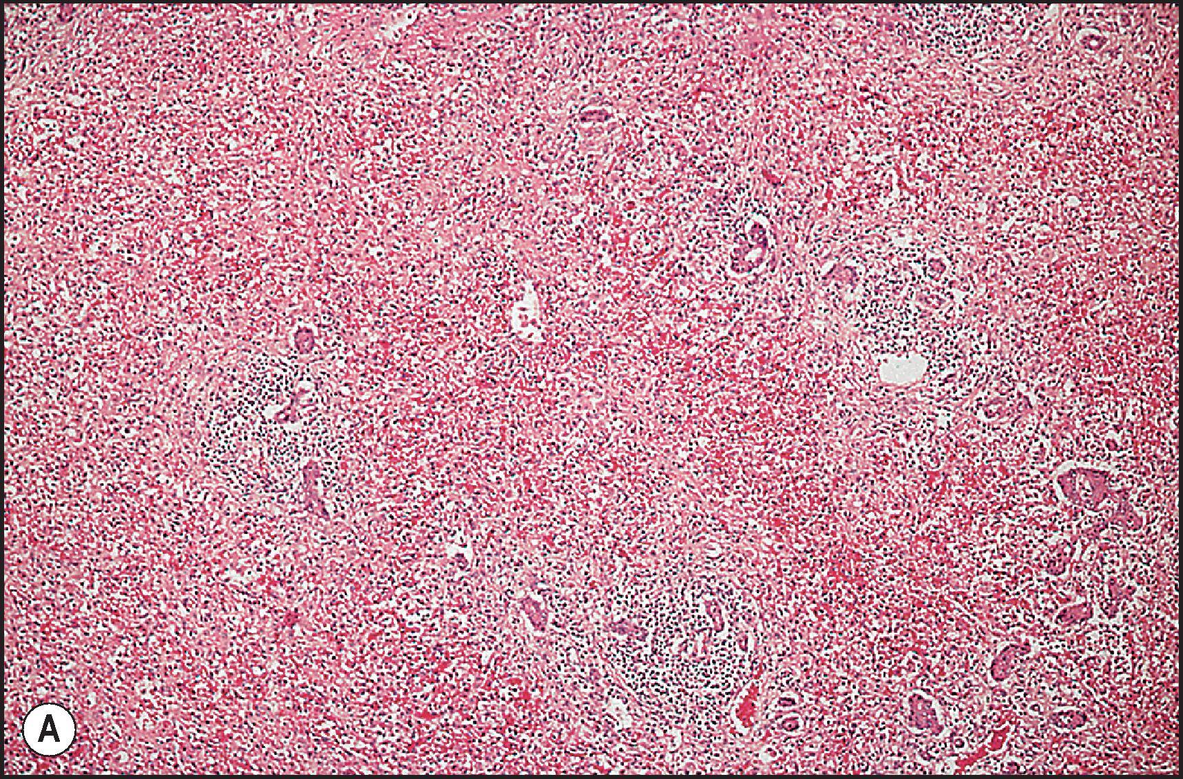 Figure 12.4, Phenytoin injury. (A) Acute massive hepatocellular necrosis. (H&E.) (B) The portal area is moderately inflamed. Note periportal ductular reaction with inflammatory cell infiltration. All liver cells have dropped out. (H&E.)