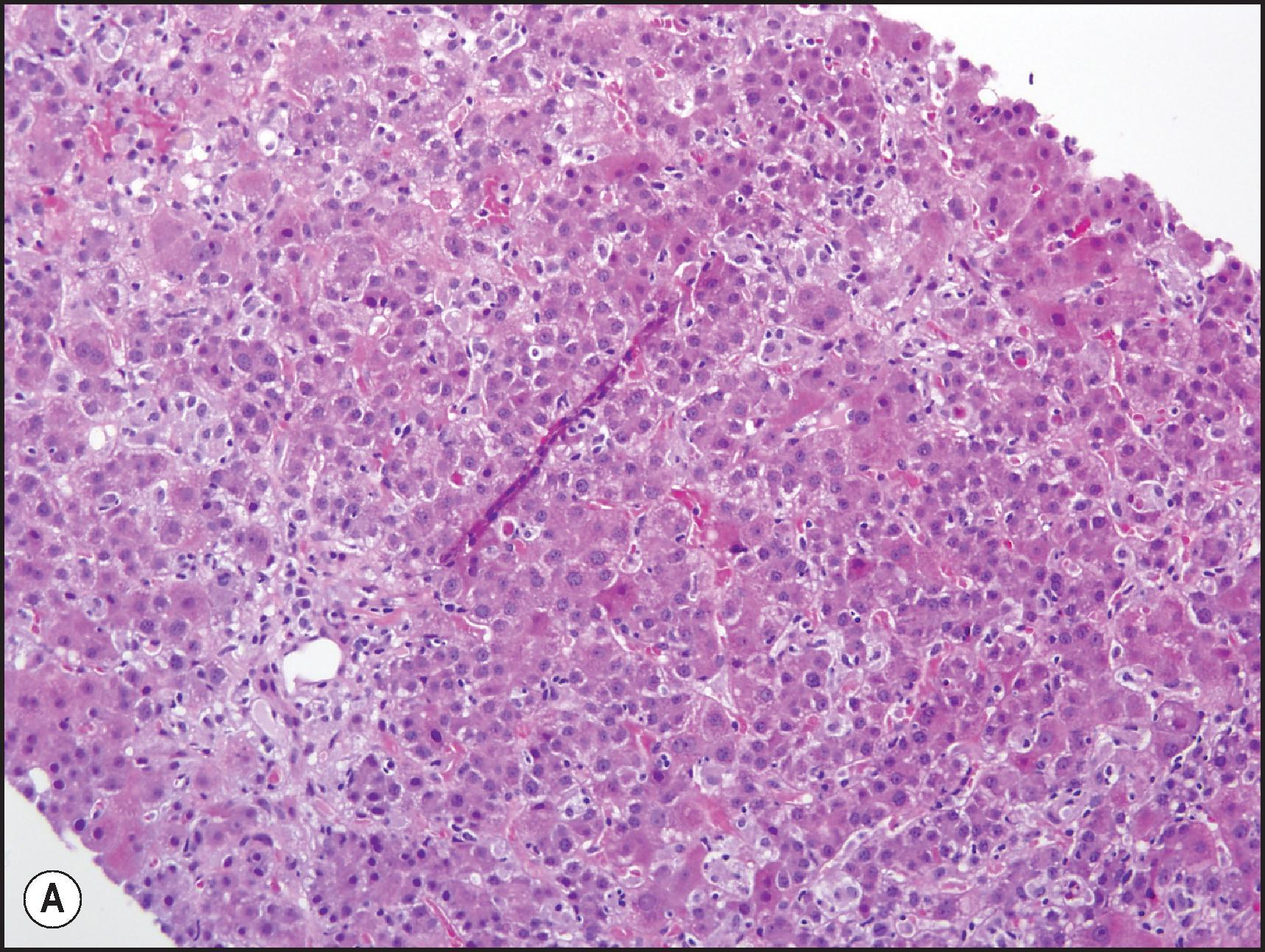 Figure 12.5, Etanercept injury. (A) Lobular disarray with hepatocyte rosette formation. (H&E.) (B) Apoptosis with lymphohistiocytic infiltrate. (C) Edge of a zone of necrosis with large aggregates of sinusoidal histiocytes. (H&E.) (D) Clusters of plasma cells at edge of necrosis. (H&E.) Case courtesy of DILIN.
