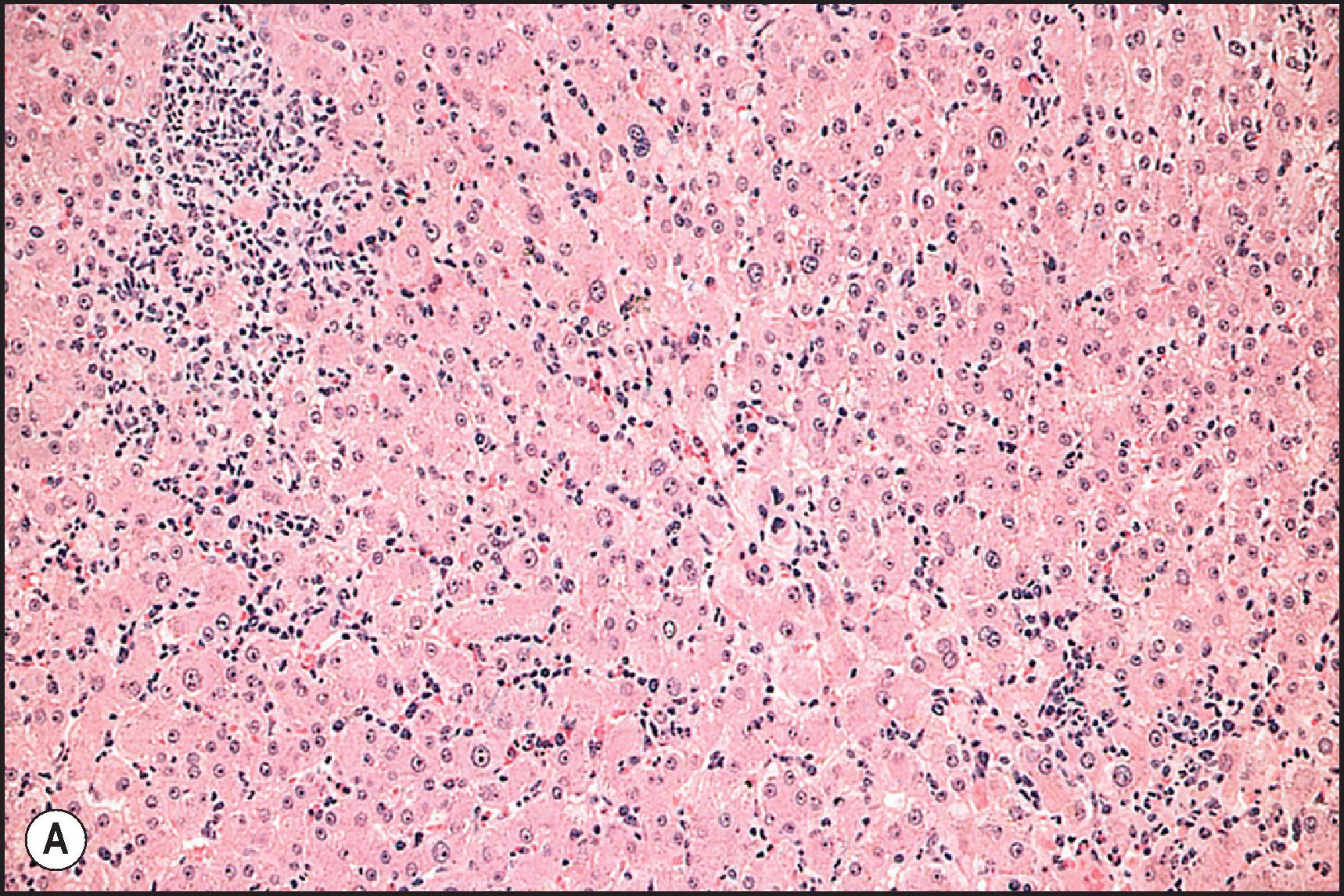 Figure 12.7, Phenytoin injury. (A) Focal necrosis and sinusoidal lymphocytosis. Portal area (upper left corner) shows moderate inflammation. (H&E.) (B) Focal necrosis, sinusoidal lymphocytosis and hypertrophy and hyperplasia of Kupffer cells. (H&E.) (C) Marked portal inflammation with mononuclear cells and eosinophils, and with ‘spillover’ into nearby parenchyma. (H&E.)