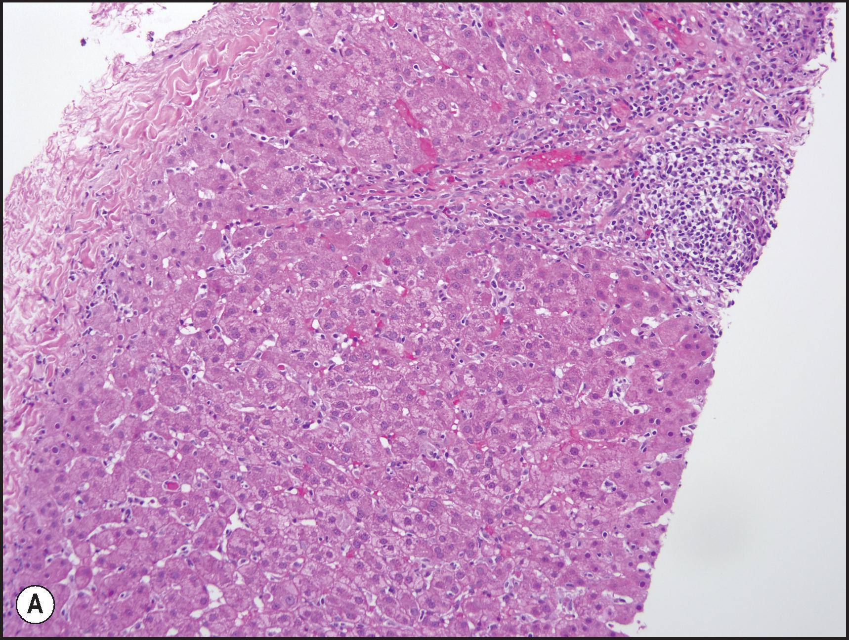 Figure 12.8, Minocycline injury. (A) Injury mimics chronic viral or autoimmune hepatitis, with dense portal inflammation and mild lobular inflammation. (B) Portal lymphoid aggregate with duct injury, interface hepatitis and rare eosinophils. Case courtesy of DILIN.