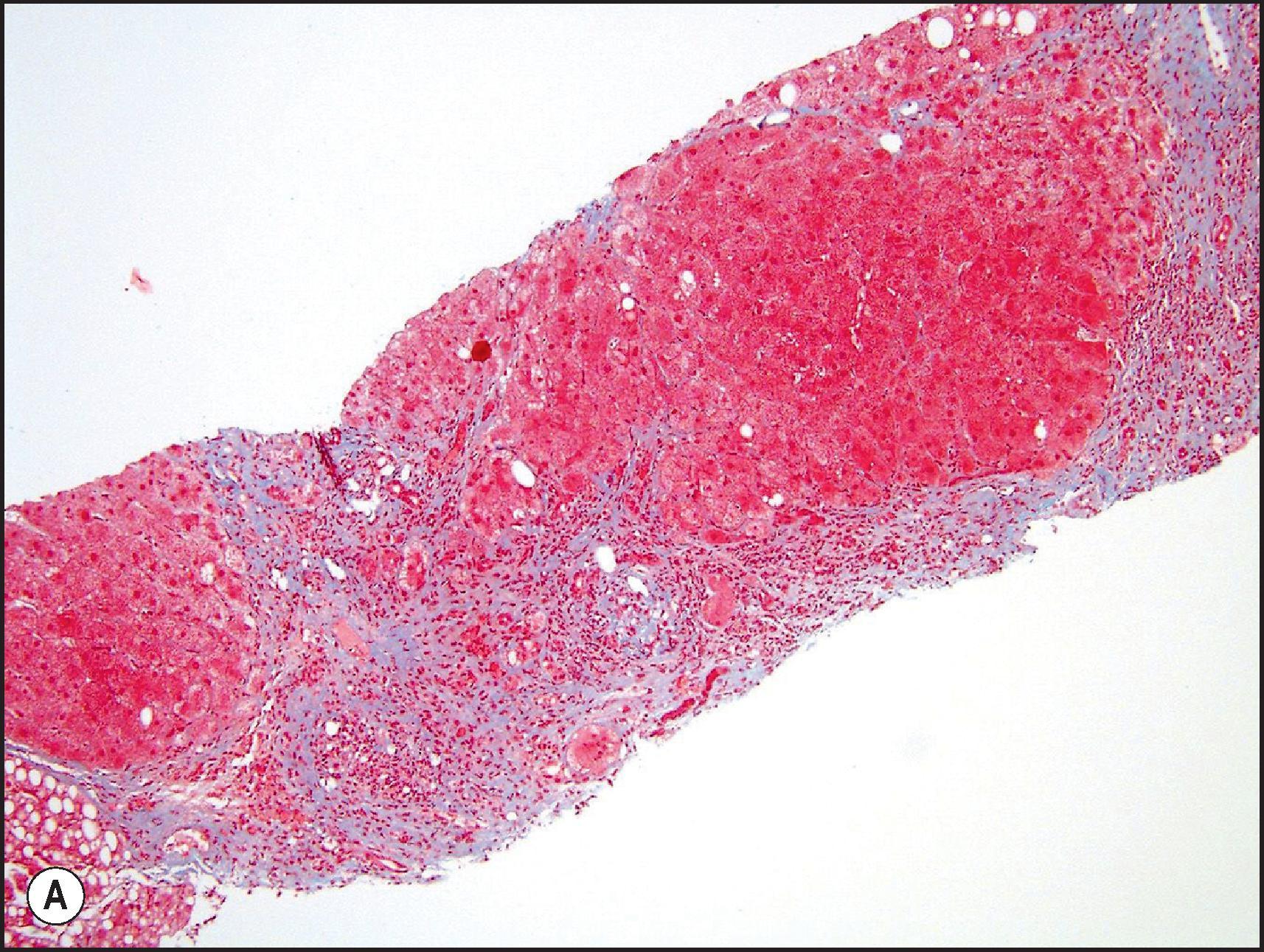 Figure 12.9, Nitrofurantoin-induced fibrosis. (A) Chronic hepatitis with bridging fibrosis and regenerative nodules showing progression to cirrhosis. (Masson trichrome.) (B) Irregular bridging fibrosis with parenchymal collapse. (Masson trichrome.) Case courtesy of DILIN.