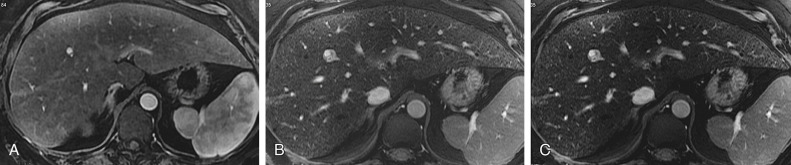 Figure 39-1, Cirrhosis secondary to hemochromatosis. A, Axial three-dimensional (3D) T1-weighted gradient echo magnetic resonance (MR) image (TE = 1.6 ms) acquired during the late hepatic arterial phase after intravenous gadolinium administration shows heterogeneous parenchyma with scattered regenerative nodules and a focal scar indenting the right lateral surface of the liver. B and C, Axial 2D intermediate-weighted gradient echo MR images with echo times of 4 (B) and 8 ms (C) acquired several minutes after gadolinium administration show considerable signal loss with an increase in echo time. The signal loss is due to T2* shortening from endogenous iron accumulation. In standard doses, gadolinium administration does not meaningfully shorten the T2* of the liver. Note that, consistent with mild cirrhosis, there are fibrotic reticulations throughout the liver; these are most pronounced in the left lateral segment.