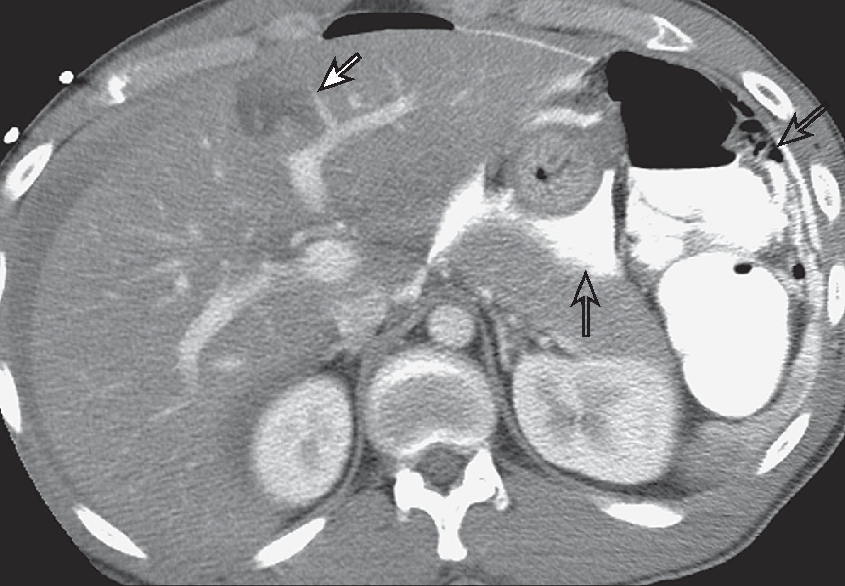 Fig. 58.1, Unsuspected hepatic laceration secondary to a gunshot to the left upper abdomen resulting in colonic perforation.