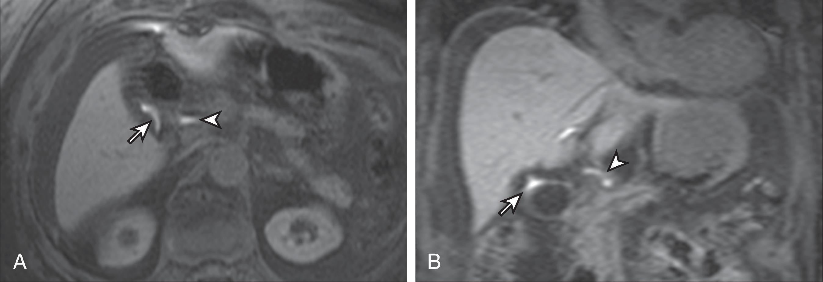 Fig. 58.13, Use of magnetic resonance imaging in demonstrating biliary leak with Eovist contrast agent.