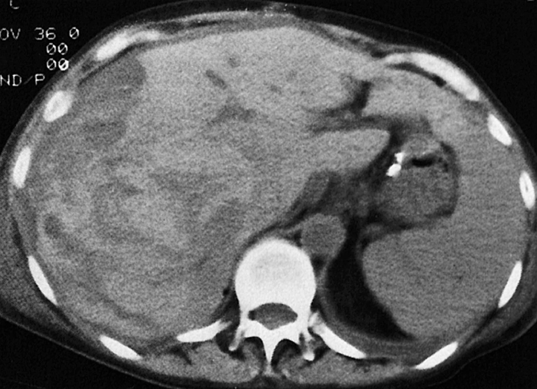 Fig. 58.2, Noncontrast appearance of hepatic laceration and hematoma.