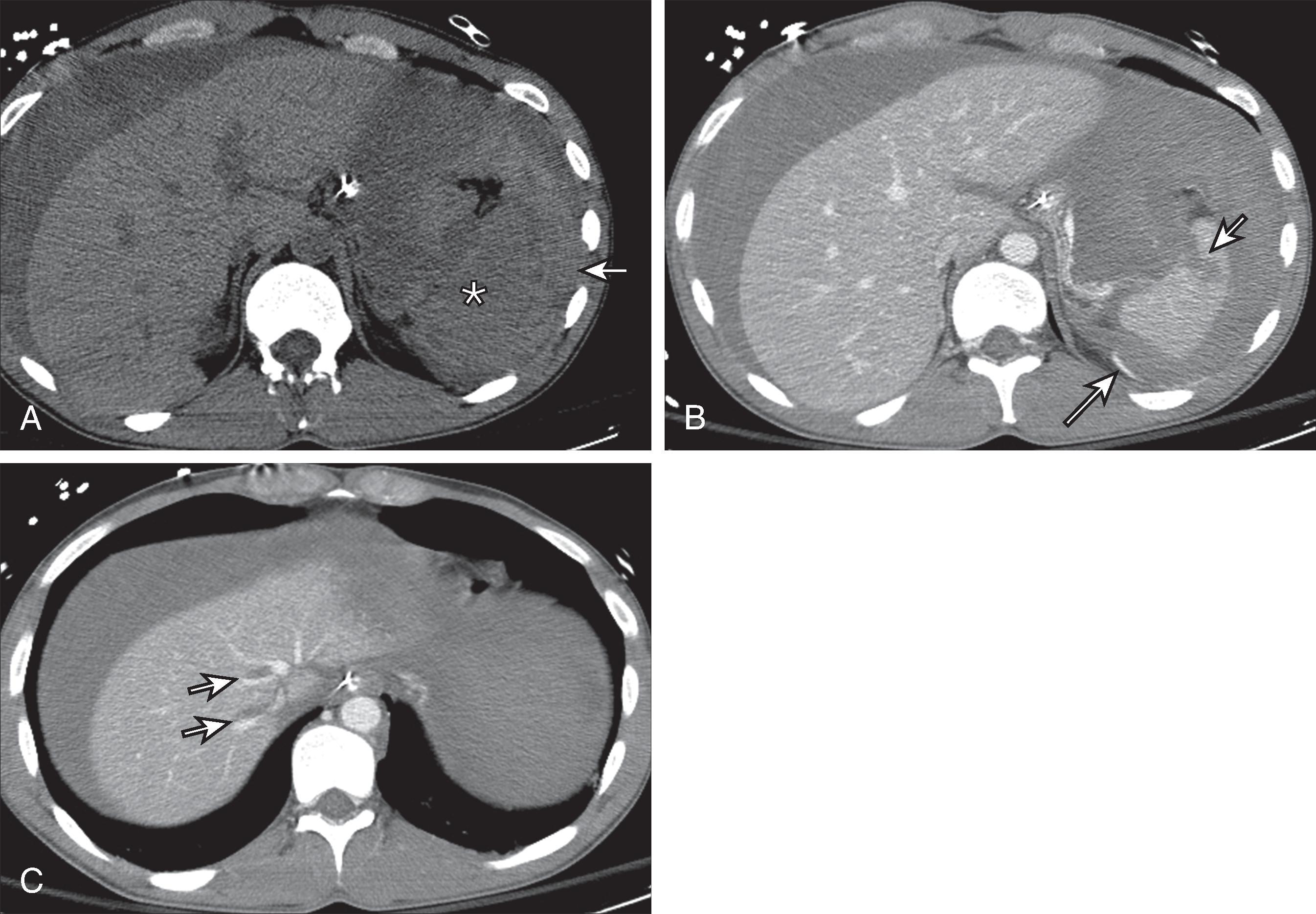 Fig. 58.3, Patient with blunt abdominal trauma from a motor vehicle accident demonstrates a sentinel clot and free intraperitoneal extravasation of contrast material.