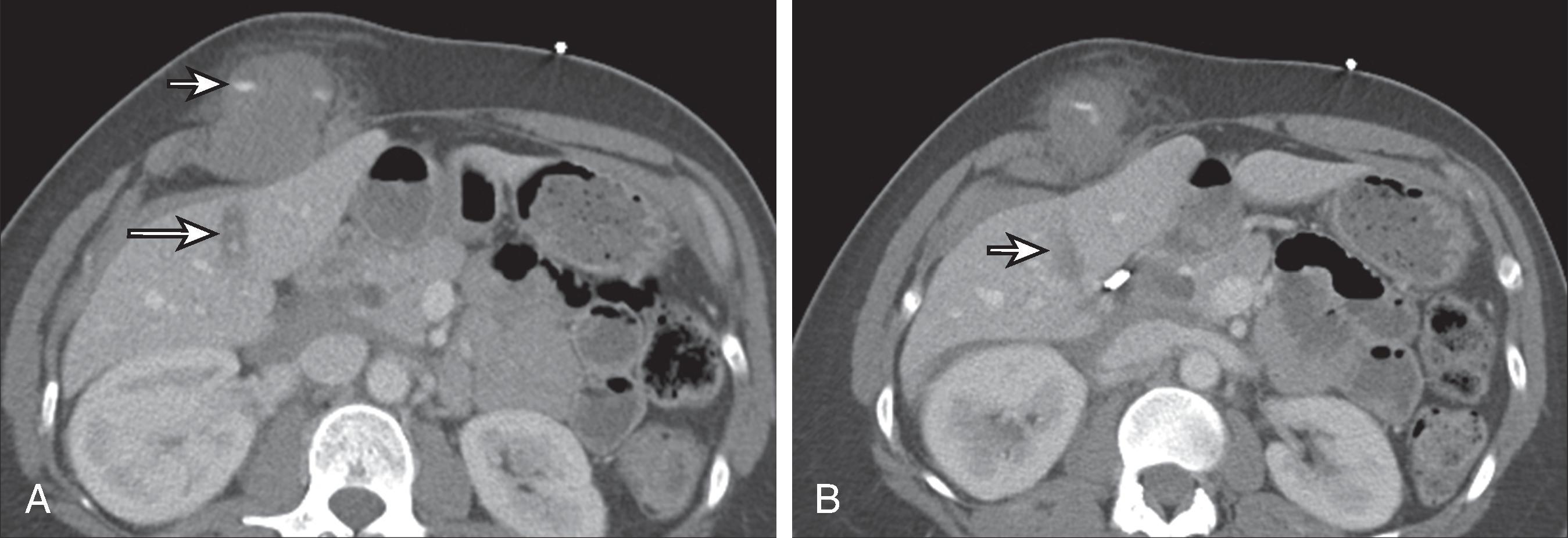 Fig. 58.4, Patient with a penetrating injury from a stab wound with a 5-inch steak knife while in the shower.