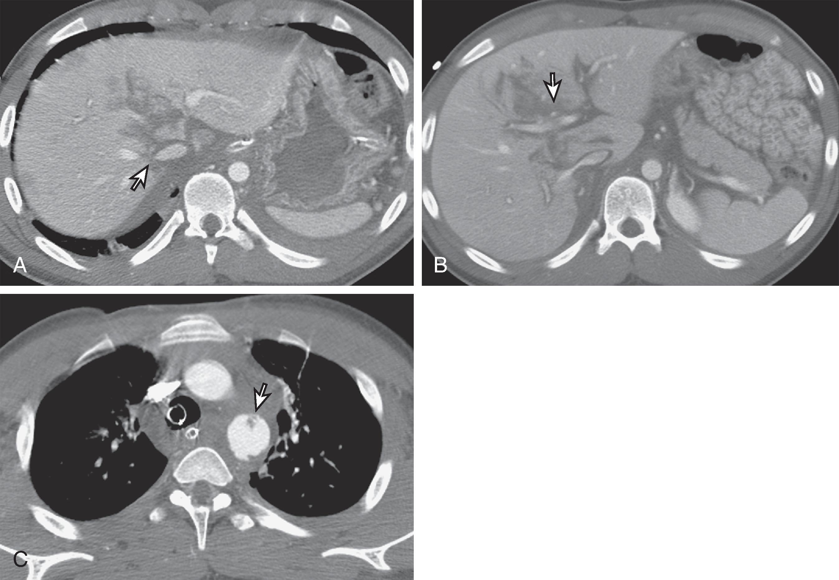 Fig. 58.5, Grade IV liver laceration and traumatic aortic injury secondary to motor vehicle collision.