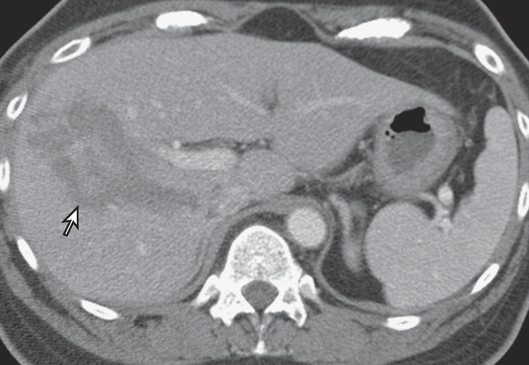 Fig. 58.6, Liver laceration with intraparenchymal hematoma.