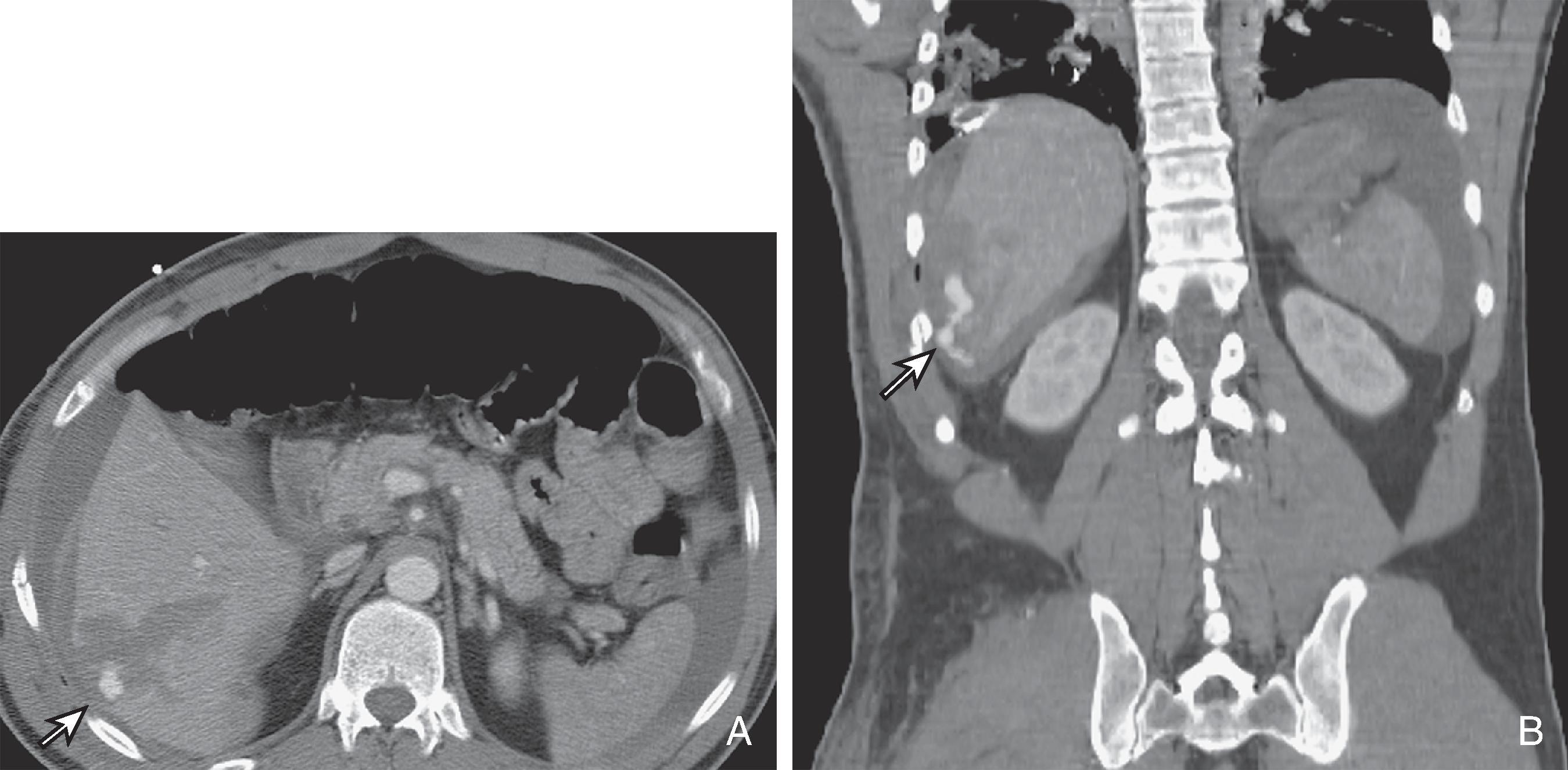 Fig. 58.7, Hepatic laceration with active extravasation.