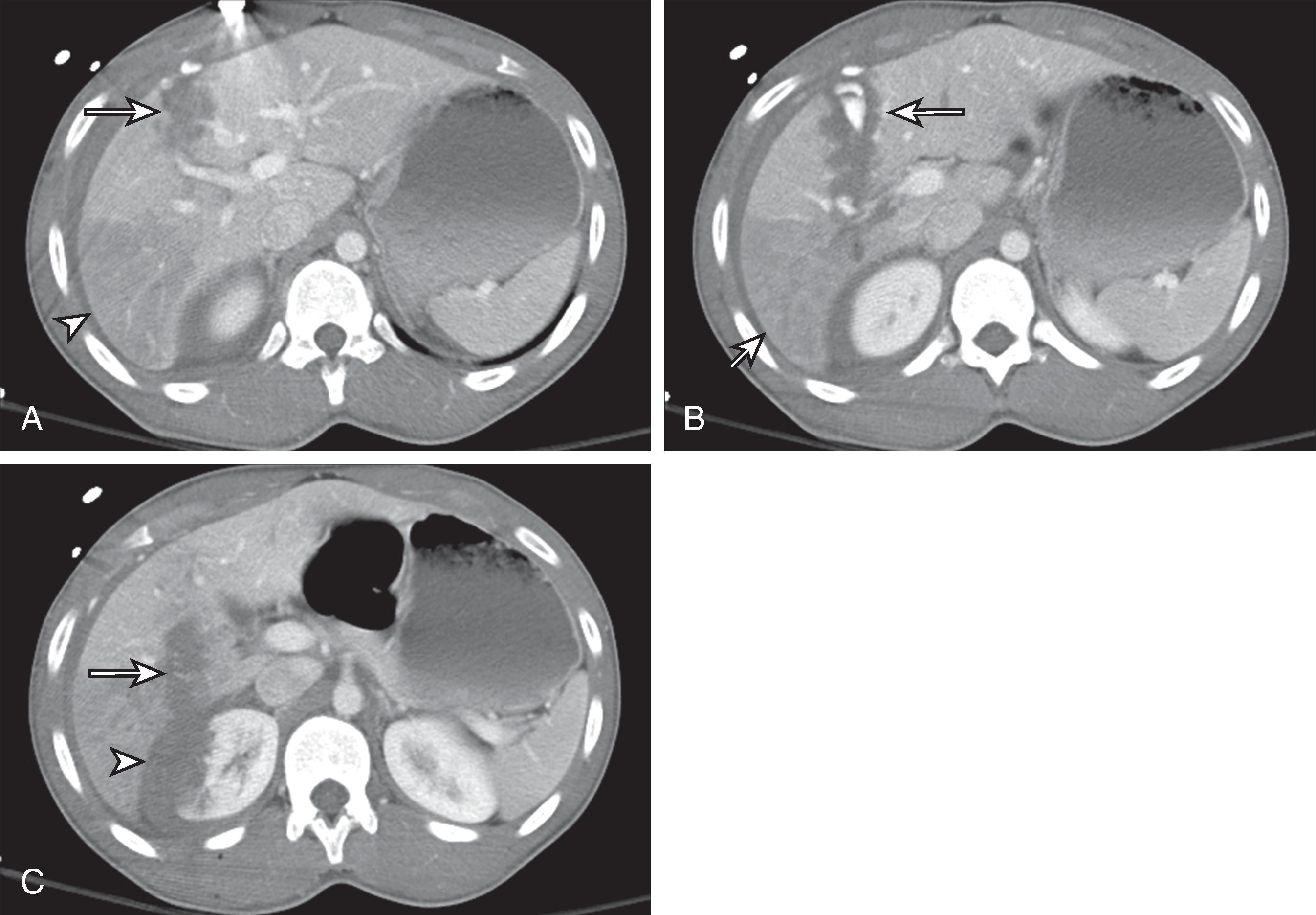 Fig. 58.8, Liver contusion and laceration with active bleeding.