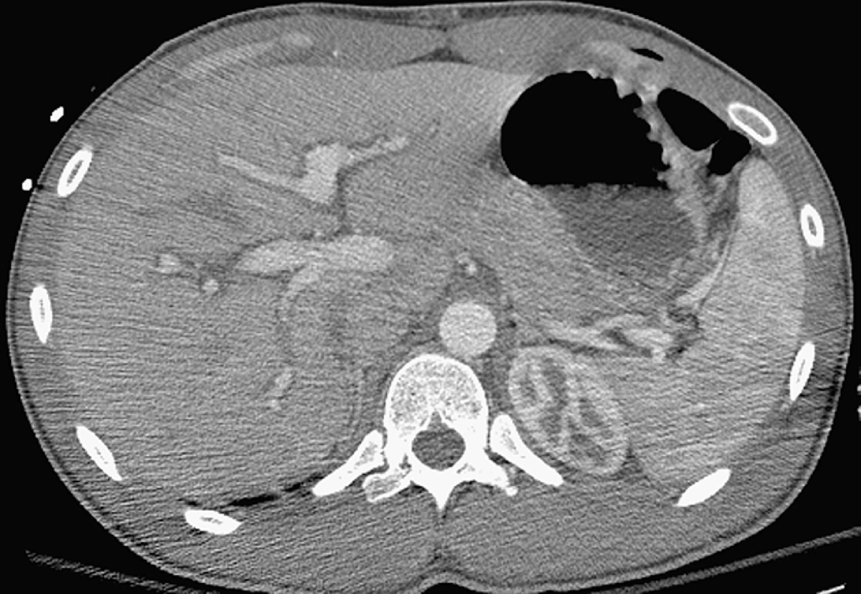 Fig. 58.9, Periportal edema secondary to aggressive hydration in a patient with a stab wound.