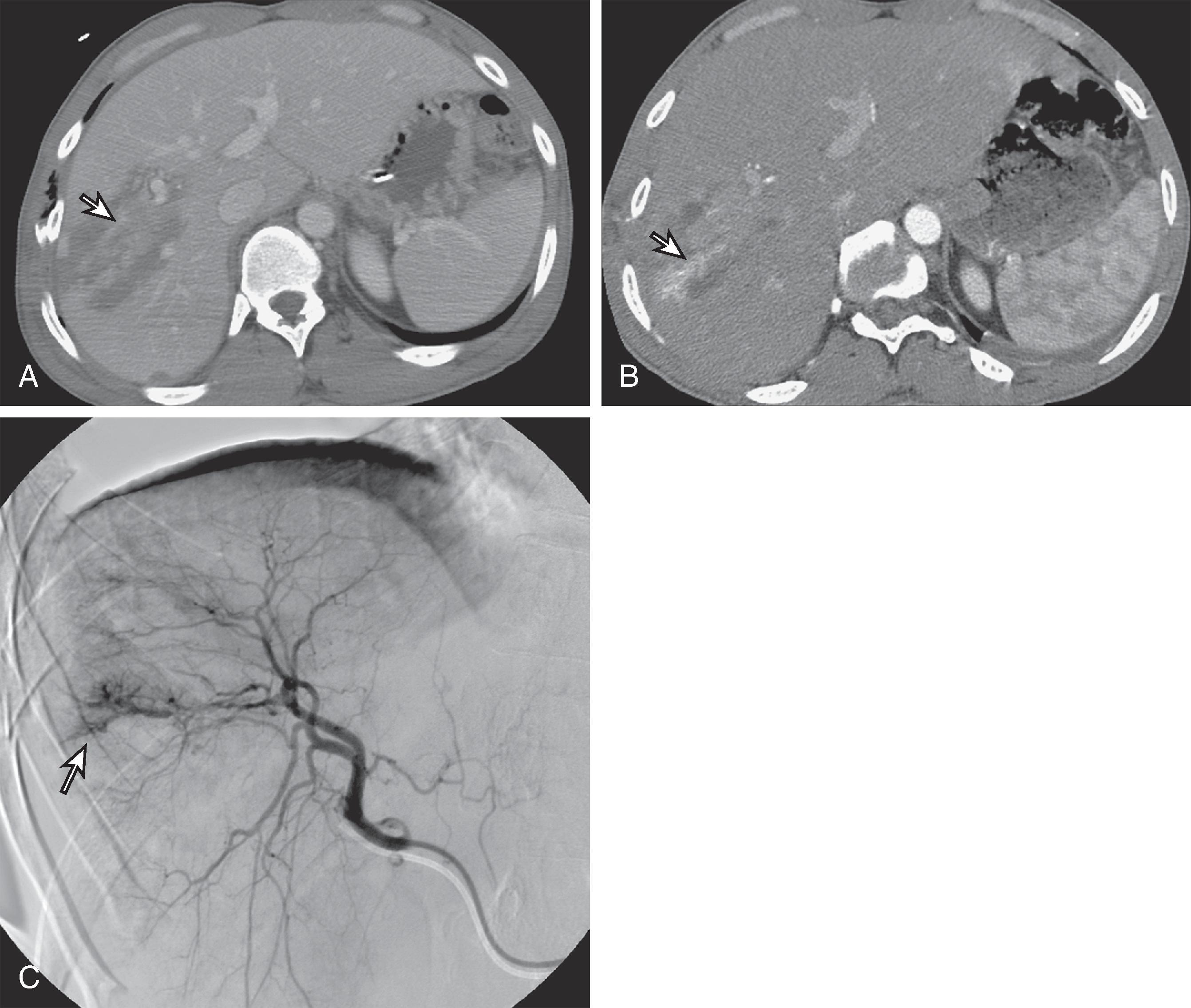 Fig. 58.10, Delayed complication of arteriovenous fistula in a patient with a liver laceration.