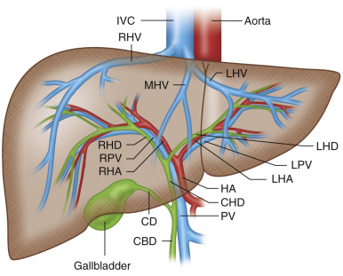 Figure 44-1, Drawing of normal anatomy of the liver. CBD, Common bile duct; CD, cystic duct; CHD, common hepatic duct; HA, hepatic artery; IVC, inferior vena cava; LHA, left hepatic artery; LHD, left hepatic duct; LHV, left hepatic vein; LPV, left portal vein; MHV, middle hepatic vein; PV, portal vein; RHA, right hepatic artery; RHD, right hepatic duct; RHV, right hepatic vein; RPV, right portal vein.