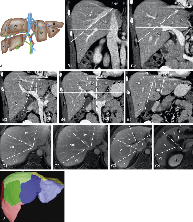 Figure 44-2, Hepatic segmental anatomy. A, Anatomic drawing of the various liver segments. Segmental anatomy of the liver in the coronal ( B1 to B5 ) and axial ( C1 to C4 ) planes from multidetector computed tomography and magnetic resonance imaging, respectively. D, Corresponding color-coded three-dimensional liver segmental reconstruction from a liver donor computed tomography examination.