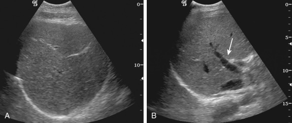 Figure 44-3, Ultrasound images of normal liver. A and B, Normal hepatic parenchyma presents as a homogeneous pattern of low-level echoes. Vessels and bile ducts appear anechoic. Right portal vein is indicated by the arrow.