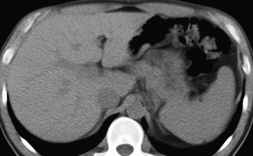 Figure 44-4, Computed tomography (CT) image of normal liver. On unenhanced multidetector CT, the liver exhibits homogeneous intermediate attenuation and appears similar to the spleen.