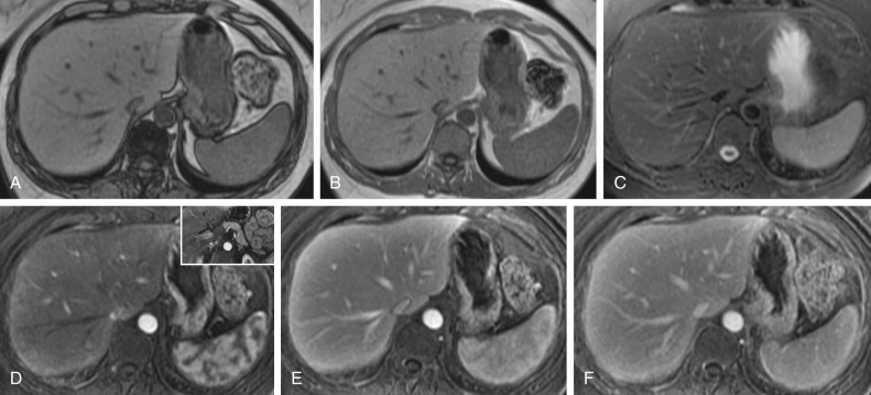 Figure 44-5, Magnetic resonance imaging (MRI) images of normal liver. On MRI, normal hepatic tissue presents hyperintense to the spleen on out-of-phase (A) and in-phase (B) T1-weighted images, is hypointense on T2-weighted images (C), and enhances homogeneously after administration of nonspecific gadolinium-based contrast media. In the arterial dominant phase of contrast enhancement, hepatic veins are unopacified (D), whereas contrast medium is detectable in the liver parenchyma and portal vein (inset). During the portal (E) and late (F) phases of contrast enhancement, both hepatic veins and parenchyma are enhanced.