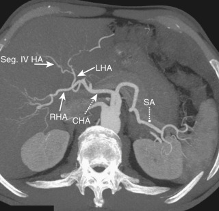 Figure 44-6, Normal hepatic arterial anatomy. Axial maximum intensity projection image shows the normal anatomy of the hepatic artery. CHA, Common hepatic artery; LHA, left hepatic artery; RHA, right hepatic artery; SA, splenic artery; Seg. IV HA, segment IV hepatic artery.