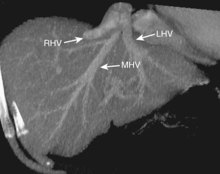 Figure 44-7, Hepatic vein confluence on multidetector maximum intensity projection coronal image. LHV, Left hepatic vein; MHV, middle hepatic vein; RHV, right hepatic vein.