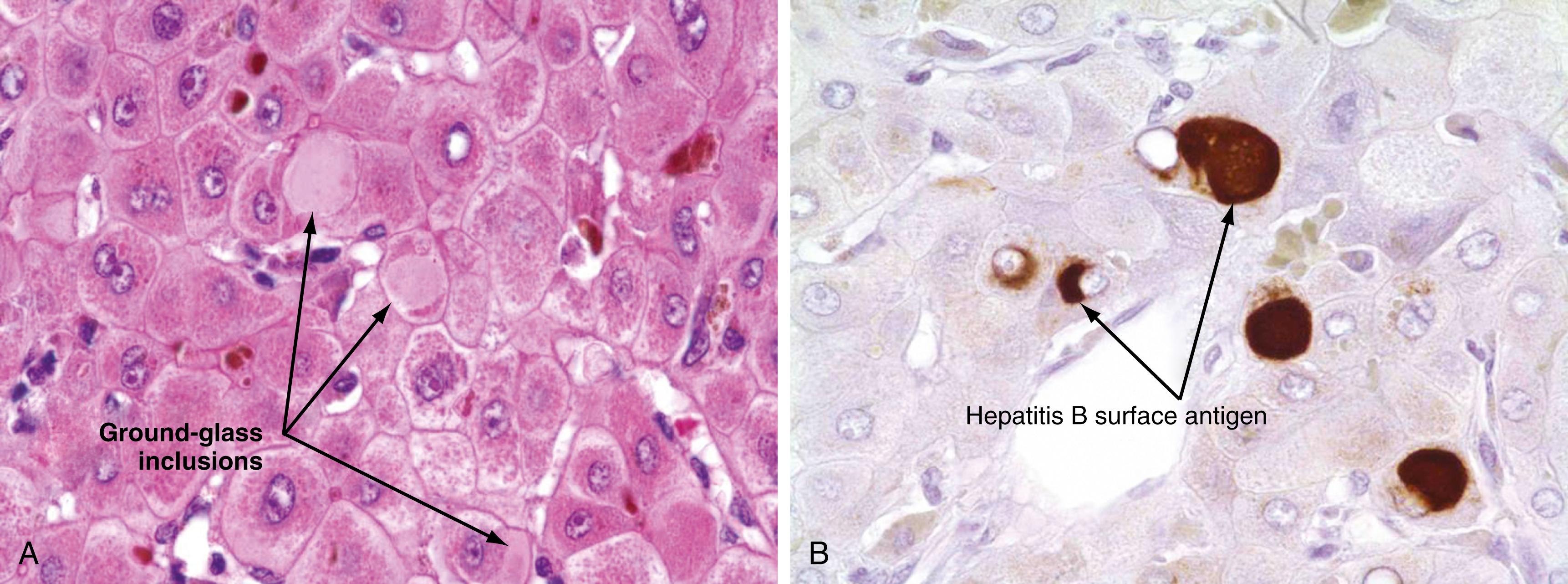 Fig. 79.5, Histopathology of HBV infection. A, Photomicrograph showing ground-glass inclusions in hepatocytes. These inclusions represent large amounts of hepatitis B surface antigen (HBsAg) in the endoplasmic reticulum. (H&E, ×630.) B, Immunohistochemical stain for HBsAg. Note that the brownish inclusions correspond to the ground-glass inclusions seen in A. (×630.)