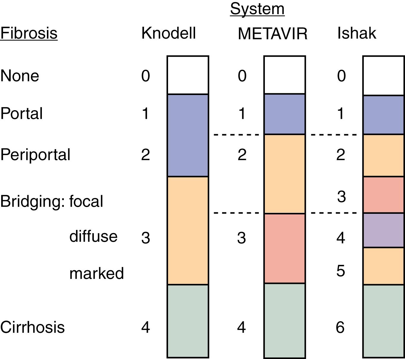 Fig. 80.4, Comparison of the Knodell, METAVIR, and Ishak hepatic fibrosis staging systems. The METAVIR staging system is similar to the Scheuer system. Portal, periportal, bridging, and cirrhosis describe the degree (stage) of fibrosis (see also Fig. 80.5 ).