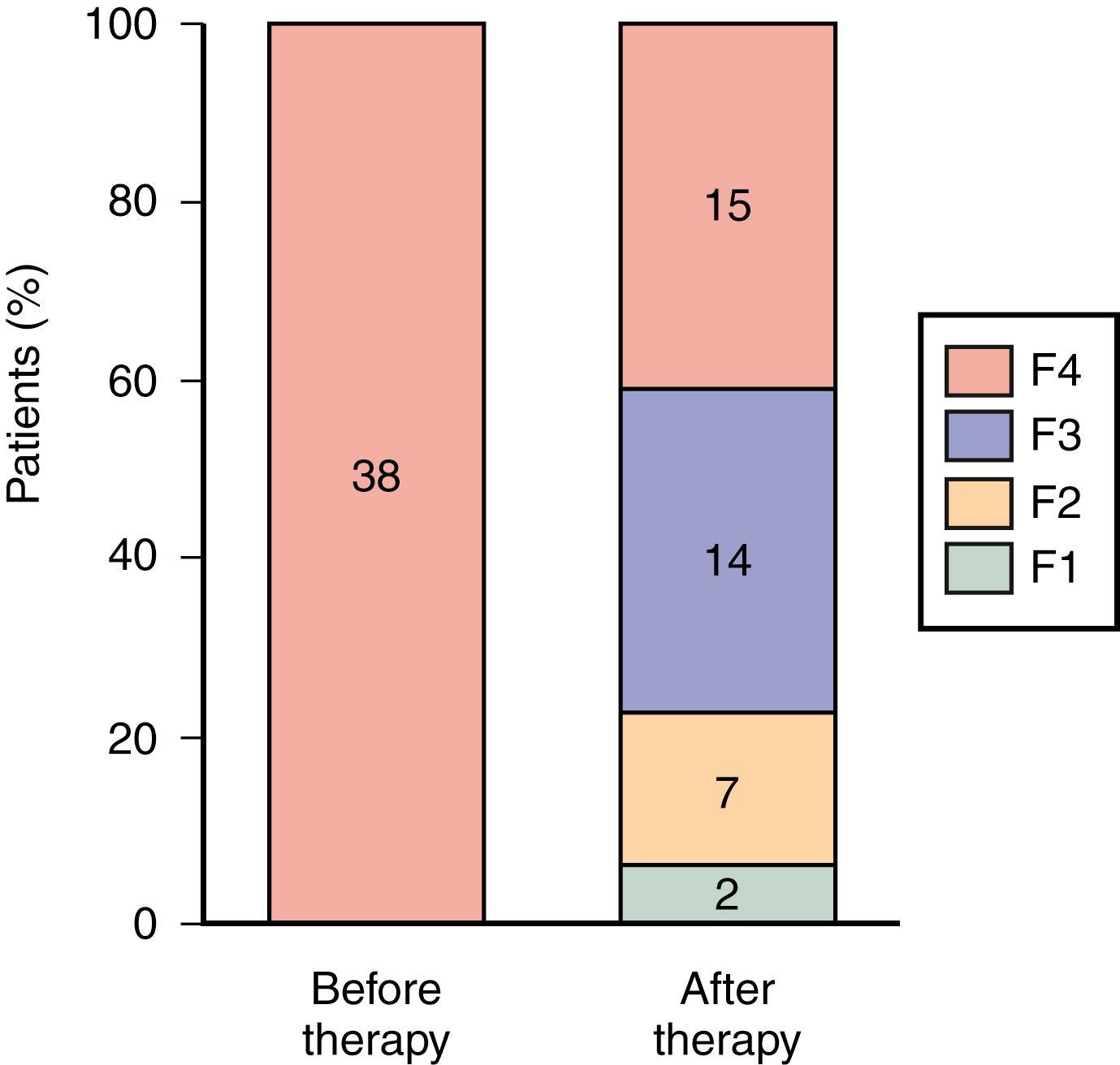 Fig. 80.6, Reversal of cirrhosis in 38 patients with chronic hepatitis C who achieved a sustained virologic response to antiviral therapy. F1 to F4 indicate stages of fibrosis, with F4 being cirrhosis.