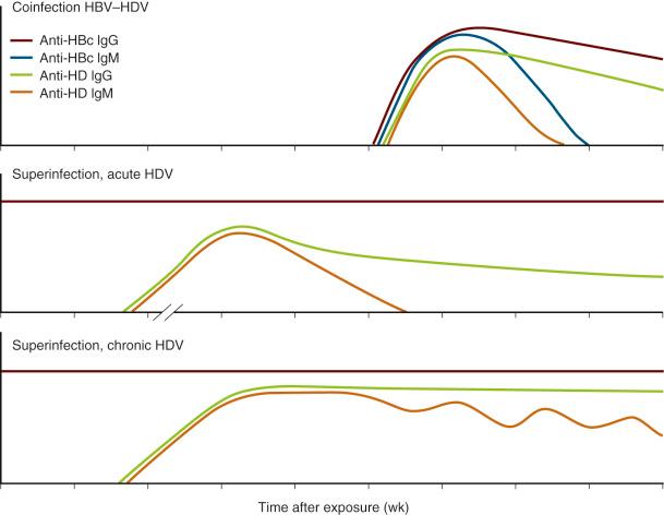 Fig. 34-6, Serologic patterns of anti–hepatitis B core (anti-HBc) immunoglobulin G (IgG), anti-HBc immunoglobulin M (IgM), anti–hepatitis delta (anti-HD) IgG and anti-HD IgM during acute coinfection with hepatitis B virus (HBV) and hepatitis delta virus (HDV) ( top ), acute HDV superinfection on preexisting HBV infection with HDV clearance ( middle ), and acute HDV superinfection on preexisting HBV infection leading to chronic HDV and HBV infection ( bottom ).