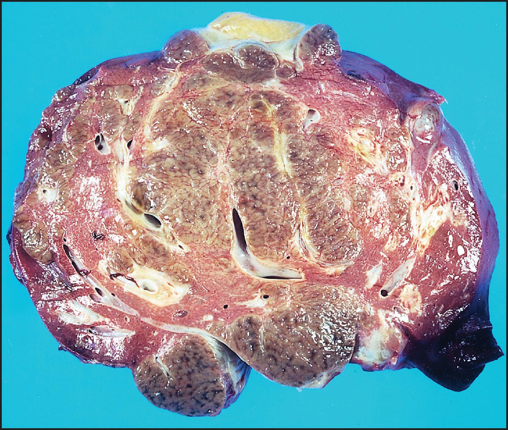 Figure 6.1, Massive necrosis with regenerative foci in severe hepatitis that progressed to liver failure over several weeks. The tan nodular zones represent regenerative foci, and the red zones represent massive necrosis with no residual hepatocytes.