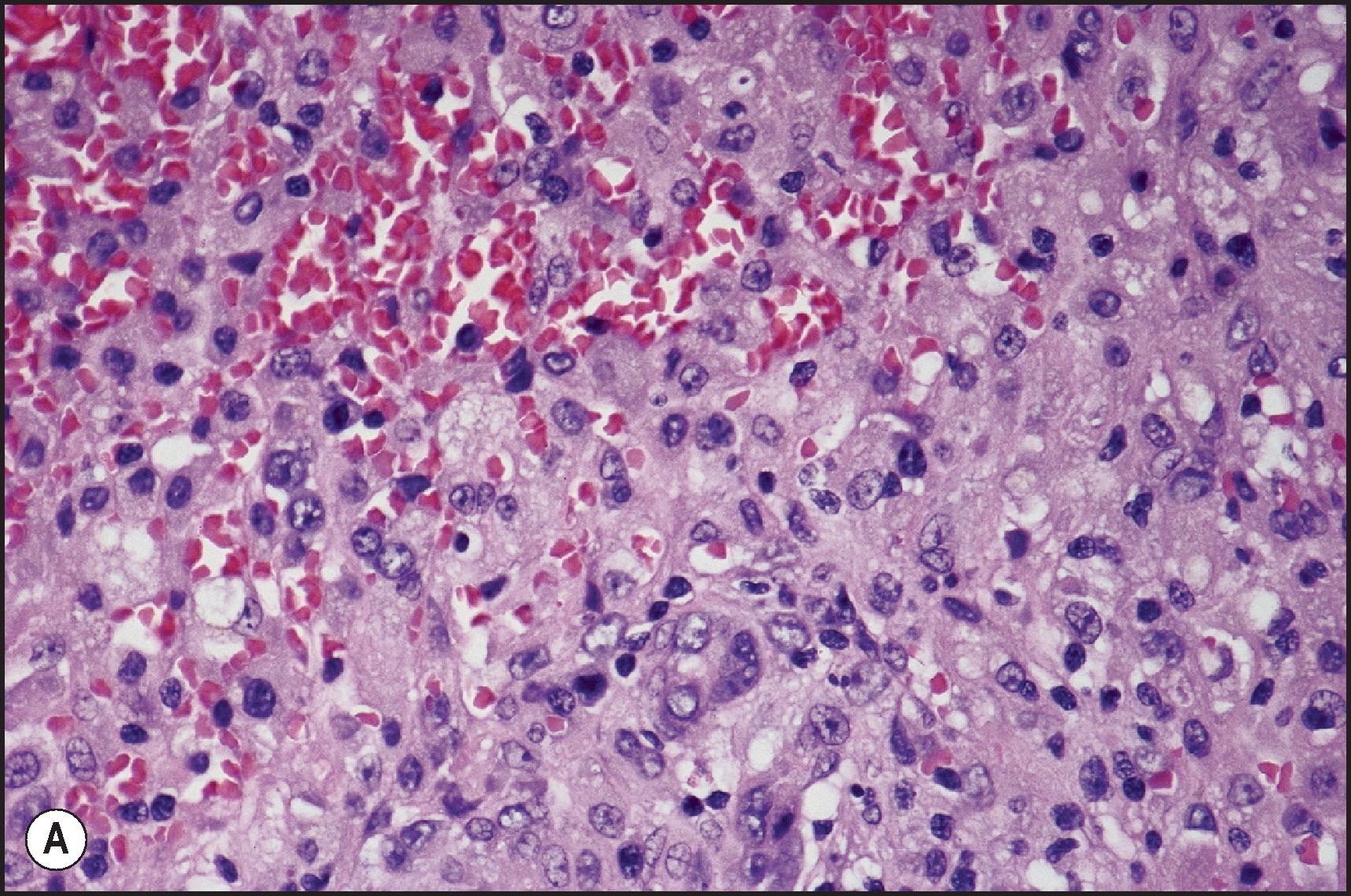 Figure 6.12, (A) Acute hepatitis with confluent necrosis. The necrotic zone is filled with macrophages. (H&E stain.) (B) Acute hepatitis with submassive necrosis. The macrophages, as seen in A, stain intensely for CD68. A few residual hepatocytes are present in upper left. (Immunoperoxidase staining for CD68.)