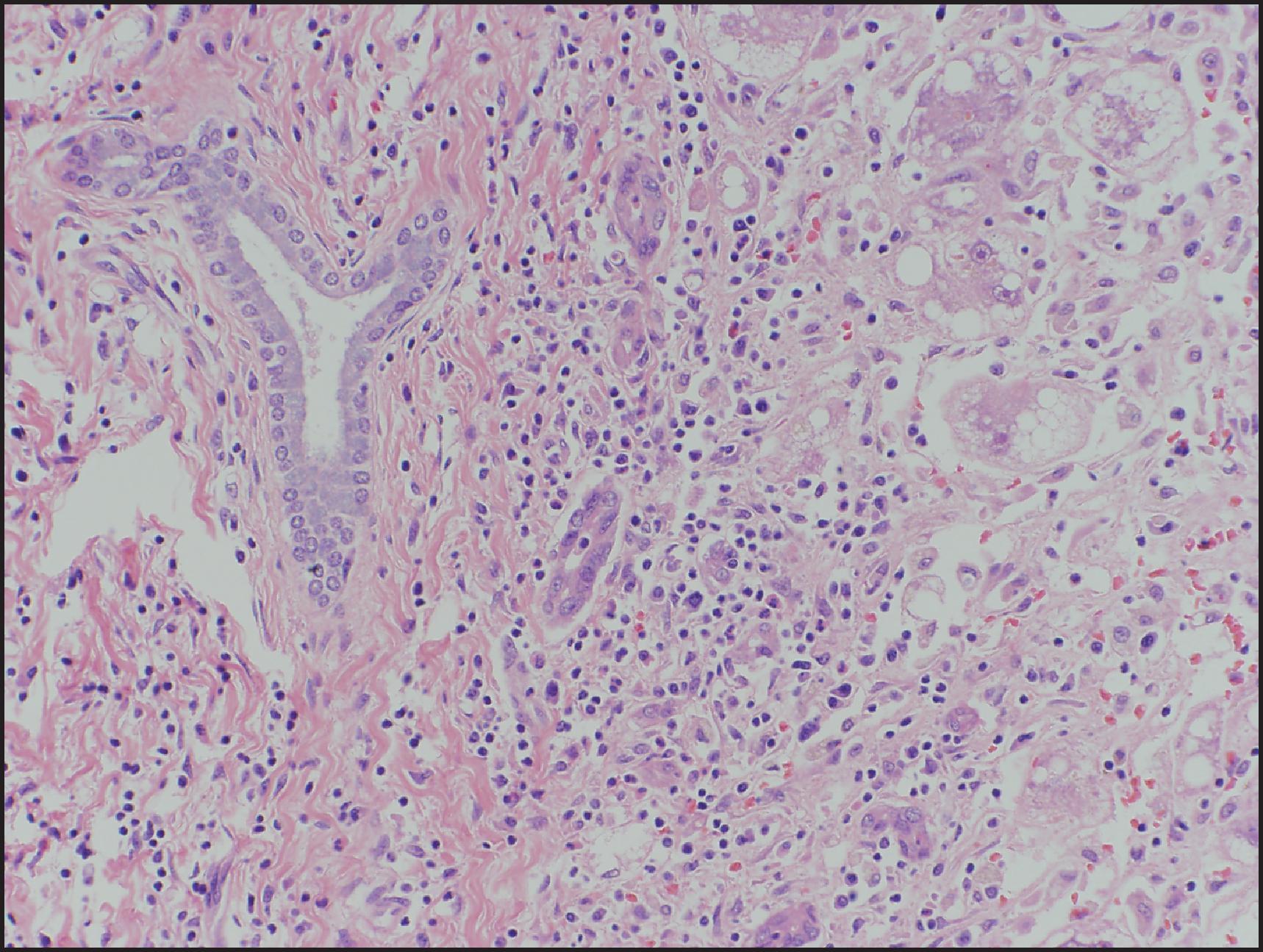 Figure 6.14, Acute hepatitis with periportal necrosis. In this example of type A hepatitis, extensive inflammation and necrosis are seen at the edge of a portal tract. (H&E stain.)