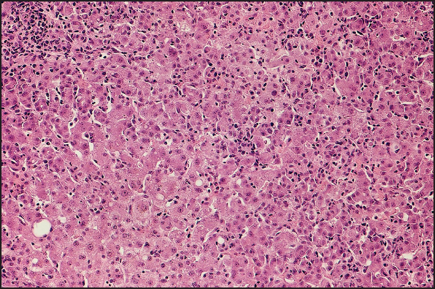 Figure 6.2, Classic acute hepatitis. Hepatocyte swelling and lymphocytic infiltrates are seen in the lobule. (Haematoxylin and eosin [H&E] stain.)